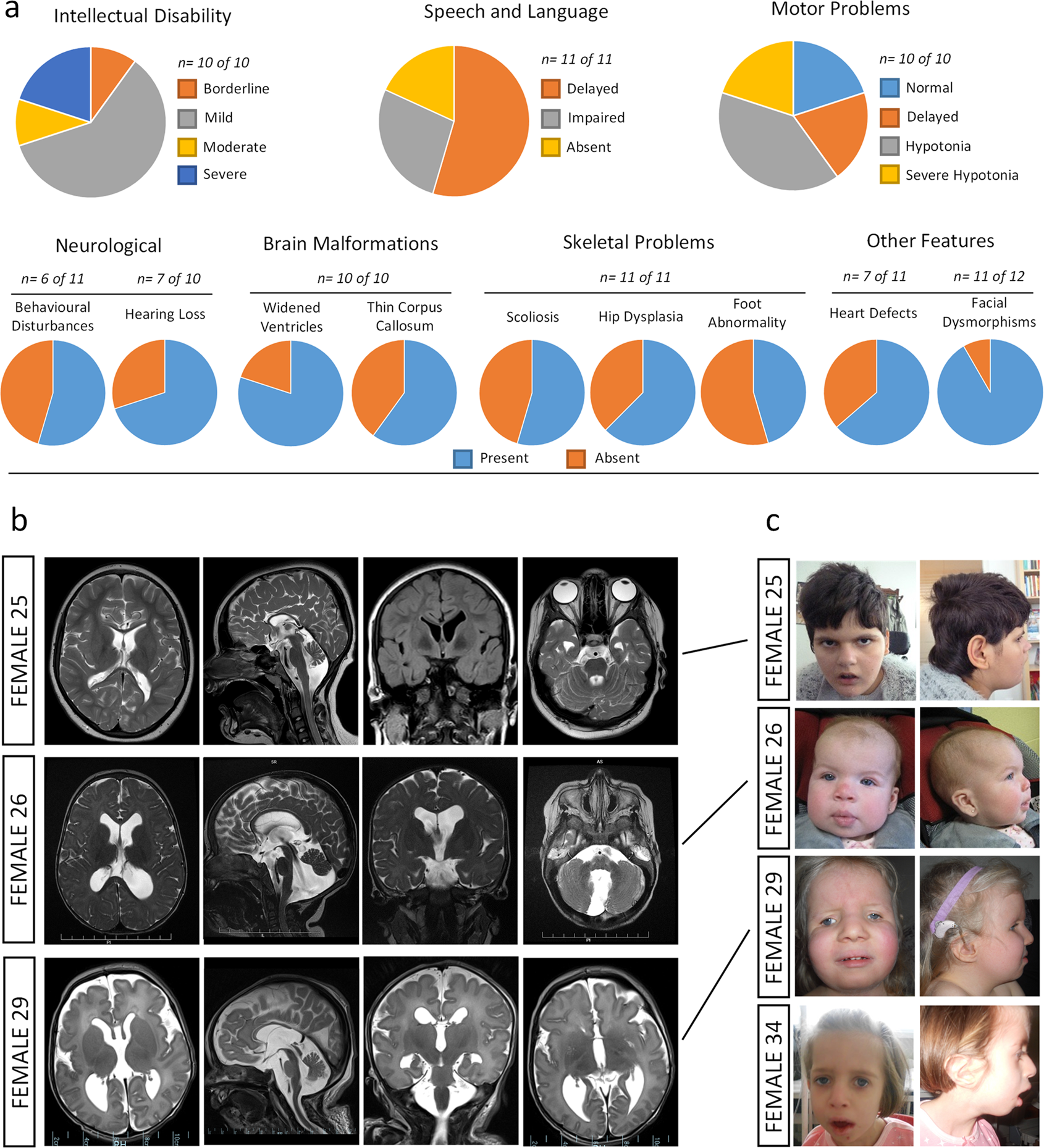 Fig. 4: Phenotypic features of females with USP9X missense and single amino acid deletion variants.