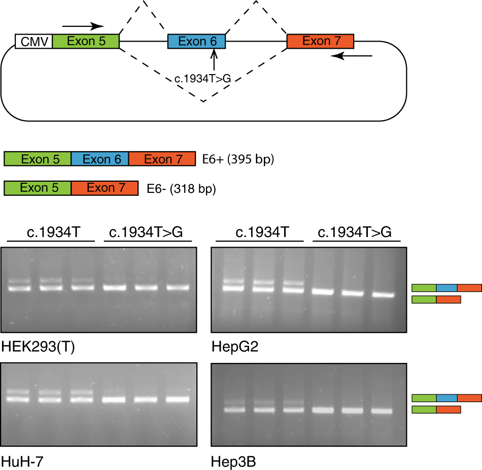Atp7b Variant C 1934t G P Met645arg Causes Wilson Disease By Promoting Exon 6 Skipping Npj Genomic Medicine