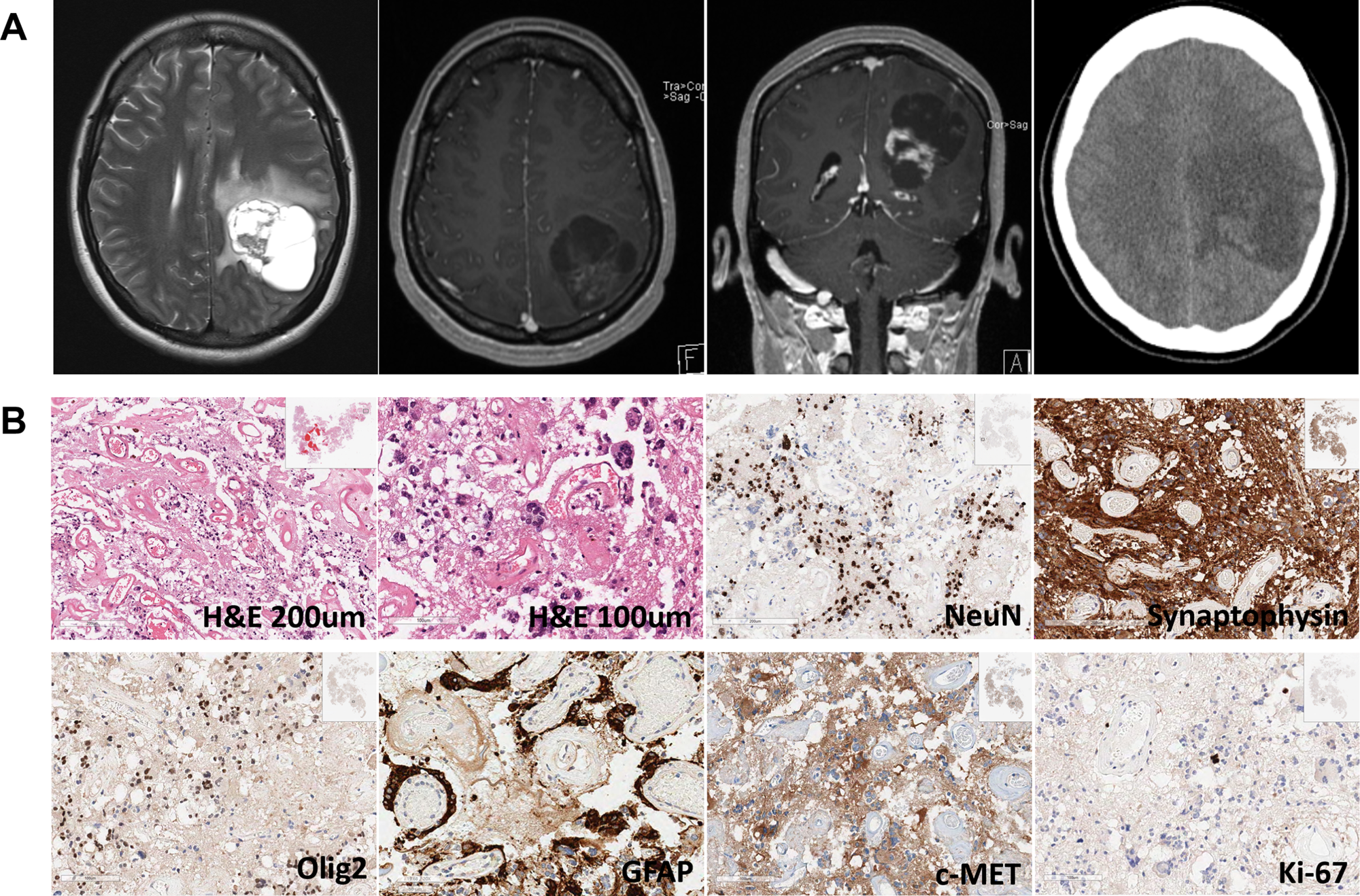 Fig. 1: Radiological and histological features of a 30-year-old glioneuronal tumor (GNT) case.