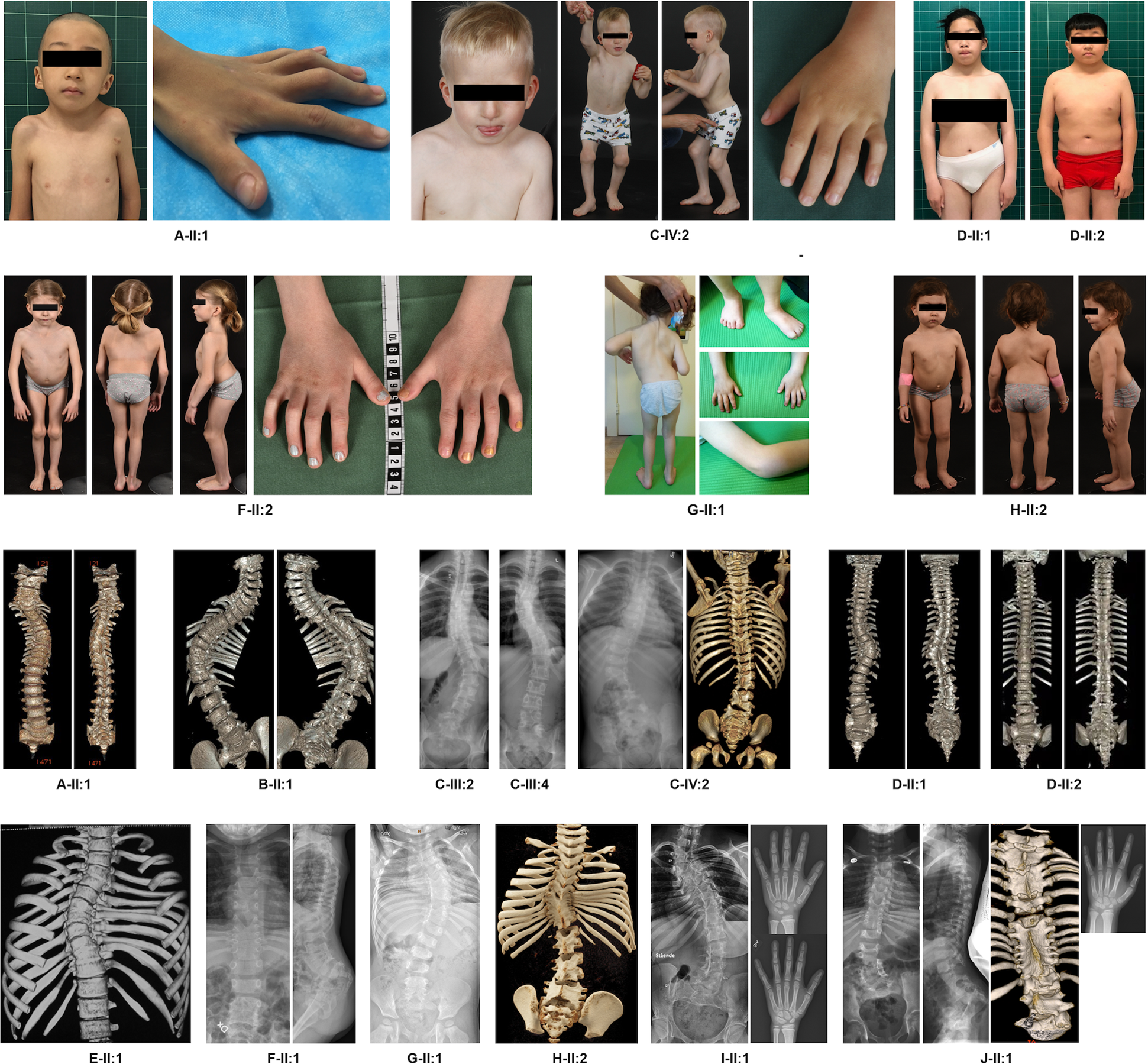 Fig. 2: Phenotypic and radiographic features of the patients with pathogenic MYH3 variants.