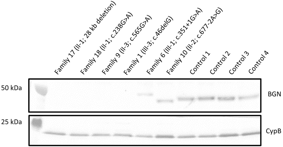 Fig. 2: Western Blot of BGN protein expression in skin fibroblasts of probands from families 1, 6, 9, 10, 17, and 18 as well as matched controls.