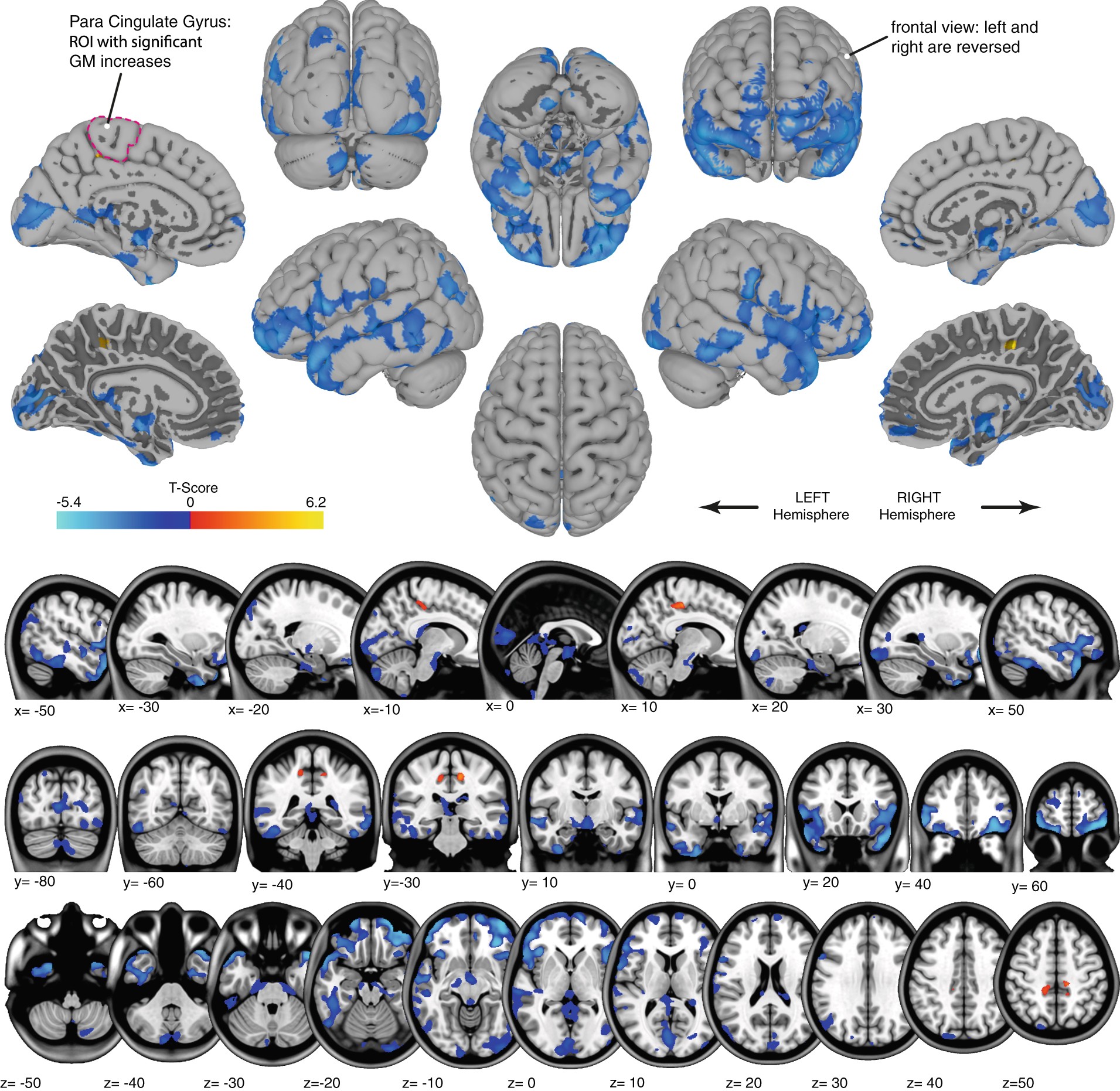 Brain structural plasticity with spaceflight | npj Microgravity