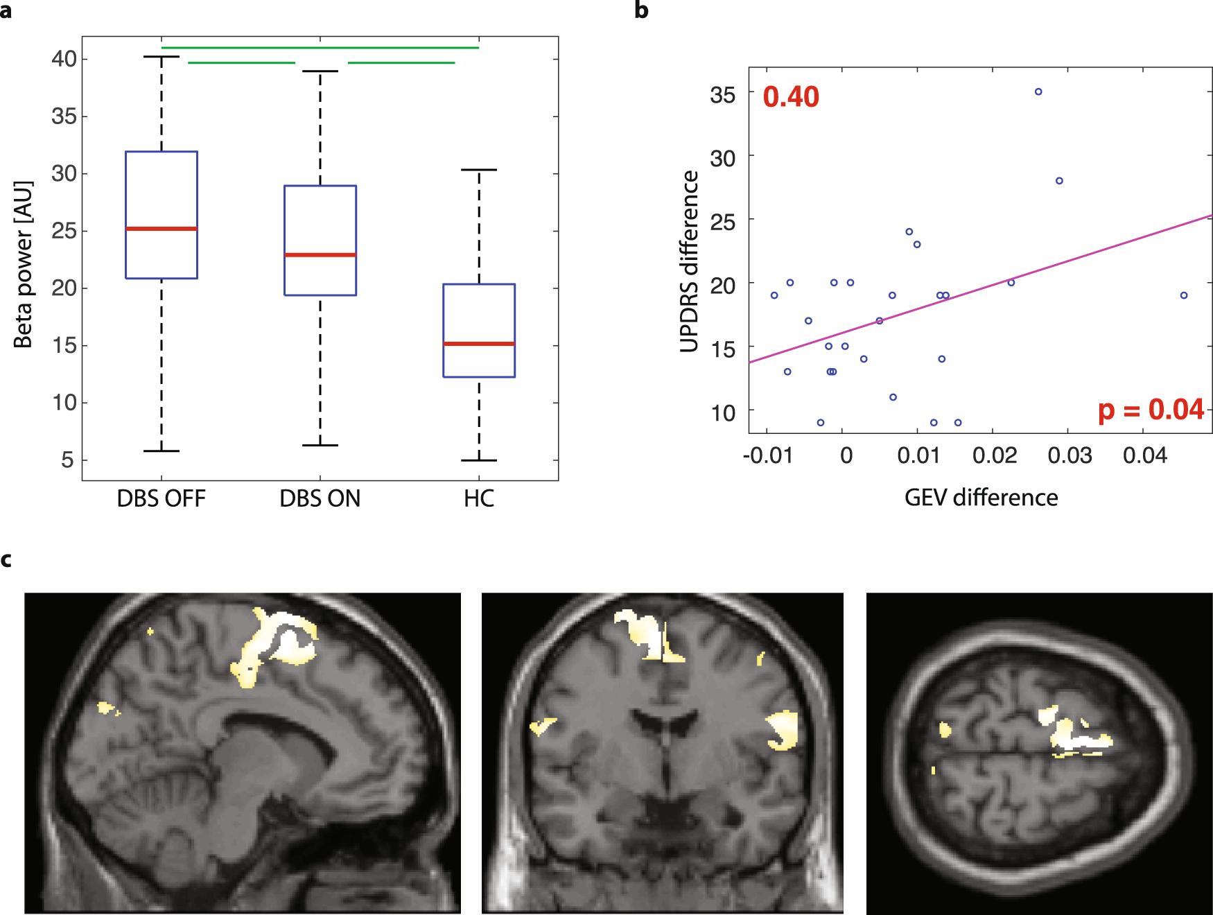 Fig. 3: The significance of the EEG microstate 4.