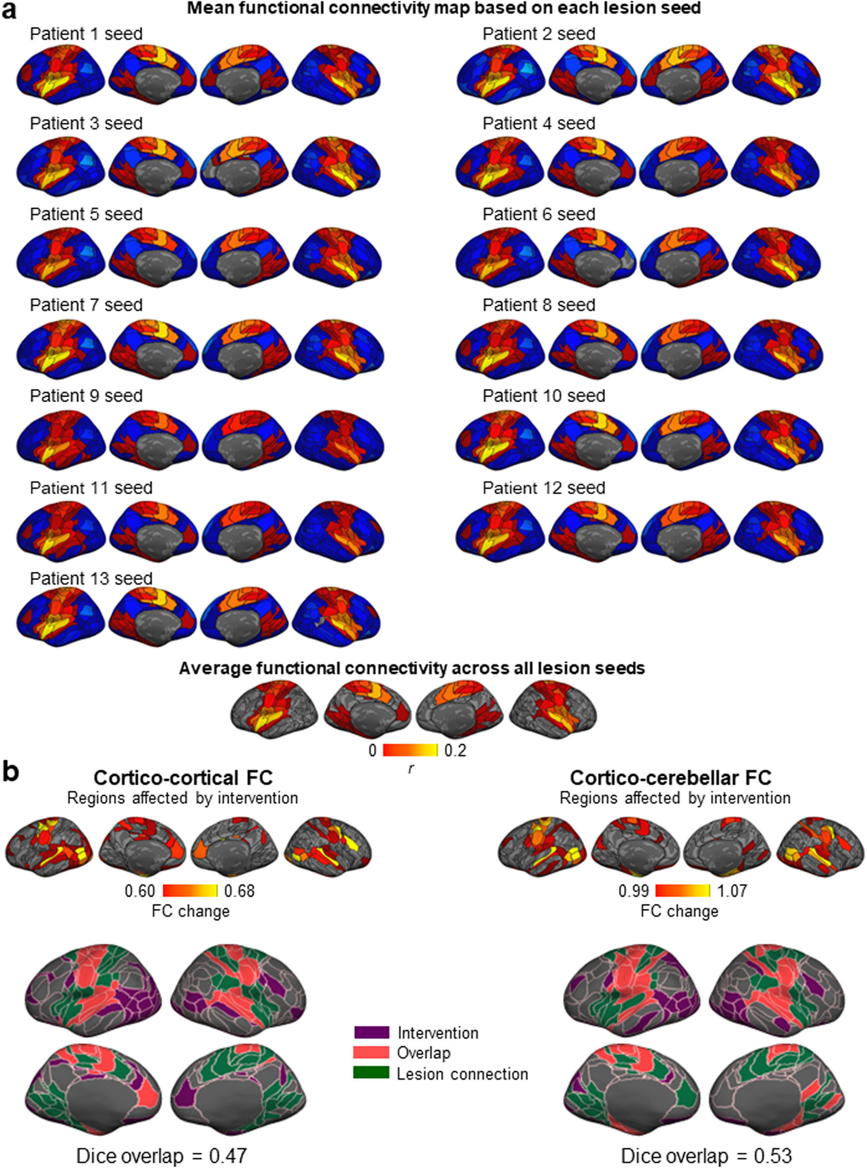Fig. 5: Regions functionally connected to the lesion sites exhibited a change in their functional connectivity following the intervention.
