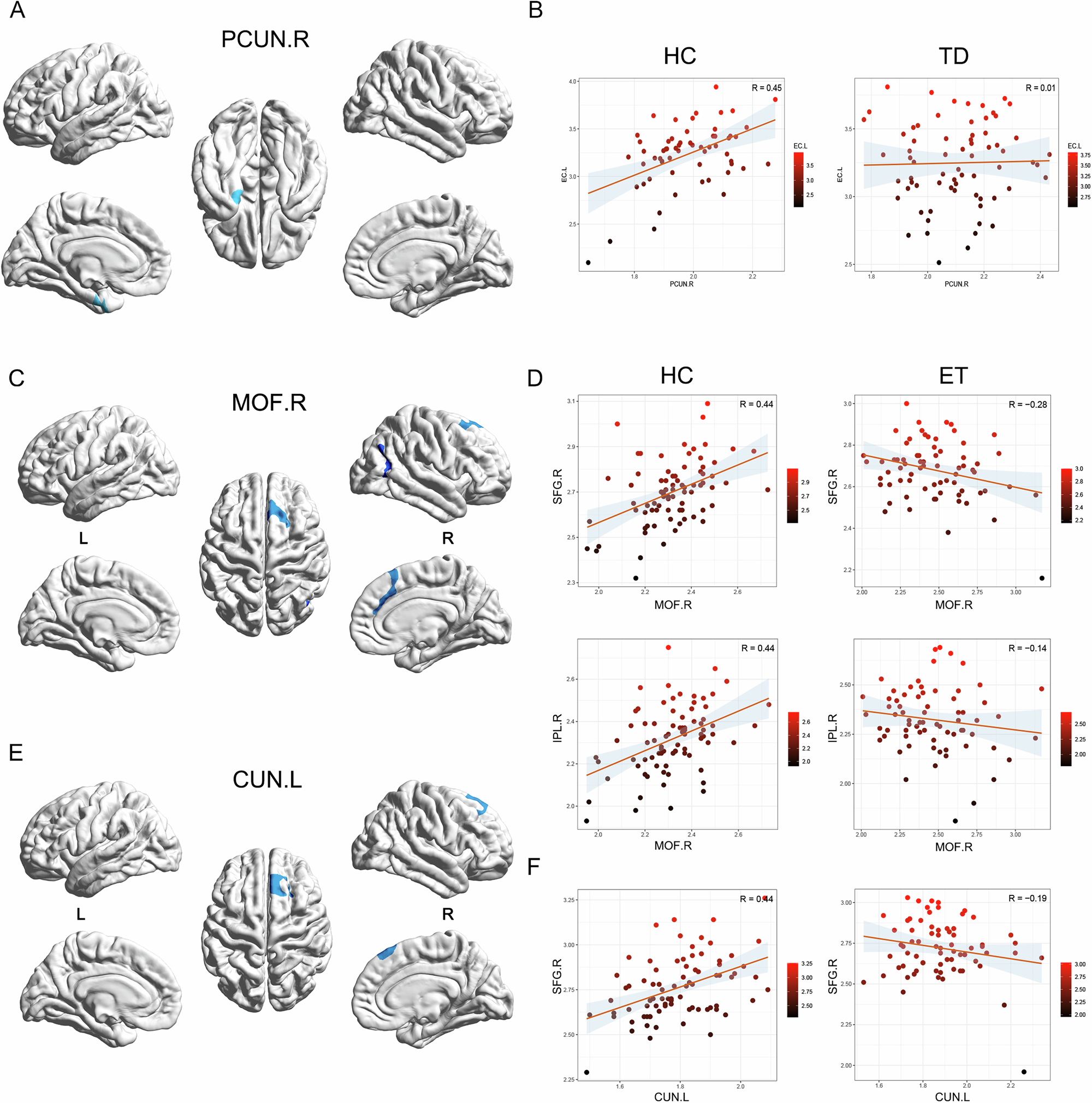 Fig. 2: Vertex-SCN results show that the brain regional covariance decreases in TD and ET patients.