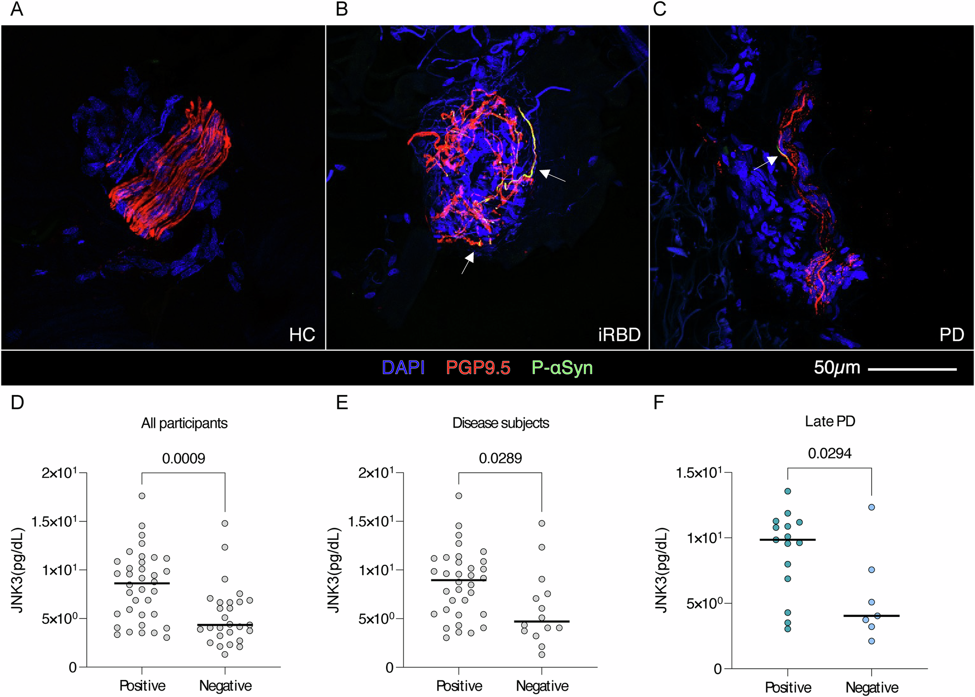 Fig. 3: Differences of JNK3 in patients positive for cutaneous phosphorylated α-Syn.
