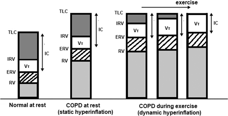 Pulmonary function testing in COPD: looking beyond the curtain of FEV1 |  npj Primary Care Respiratory Medicine