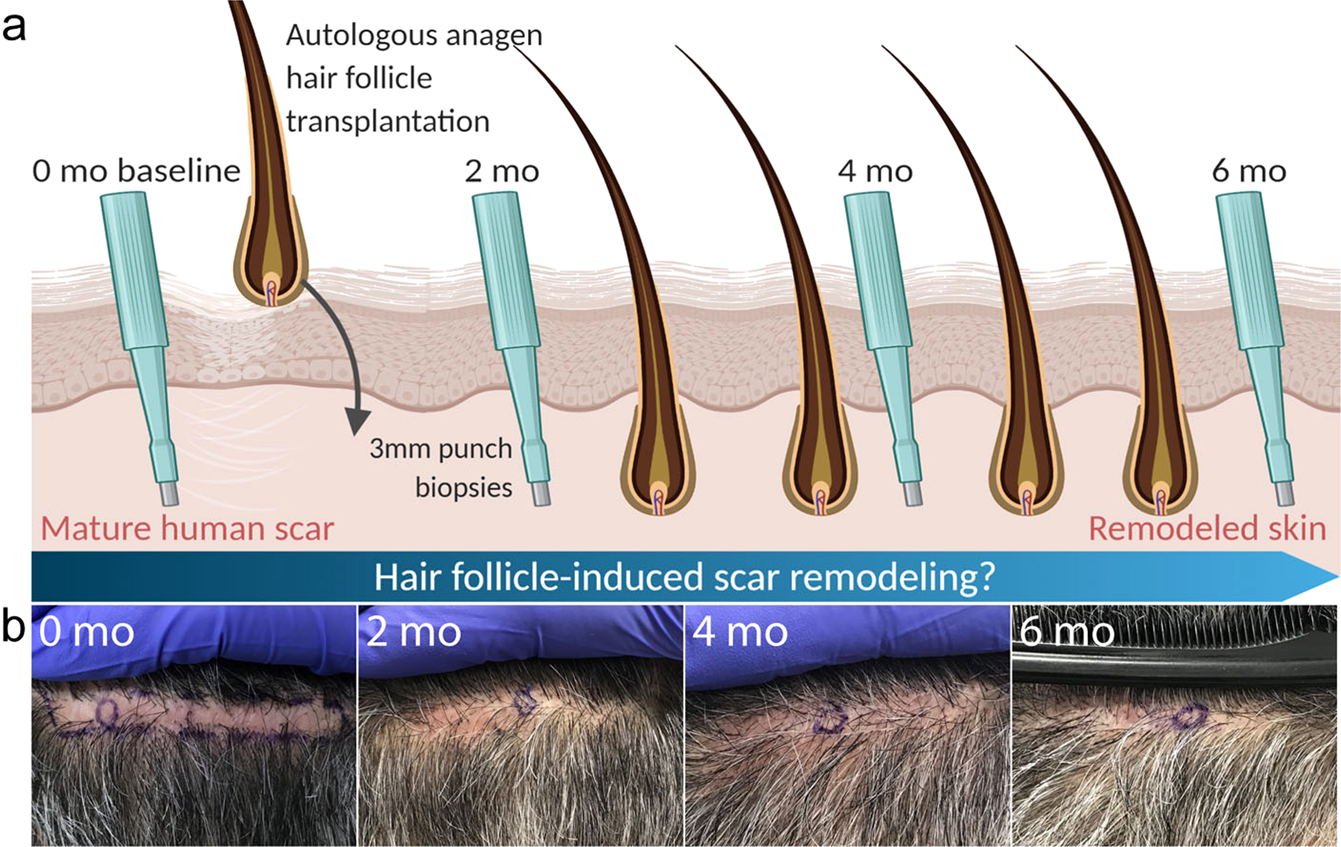 Anagen hair follicles transplanted into mature human scars remodel fibrotic  tissue | npj Regenerative Medicine