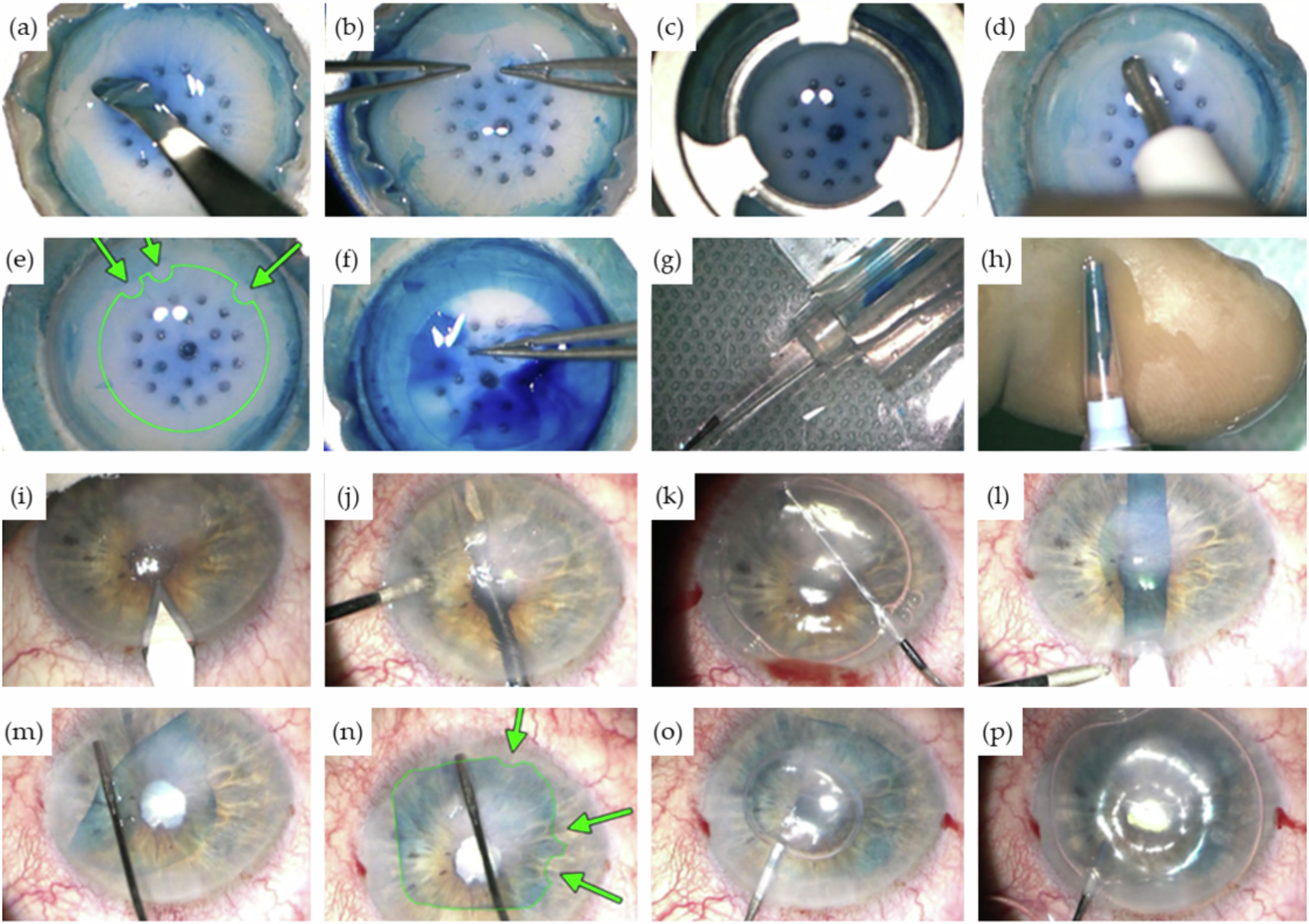 Fig. 5: Step-by-step procedure of DMEK.