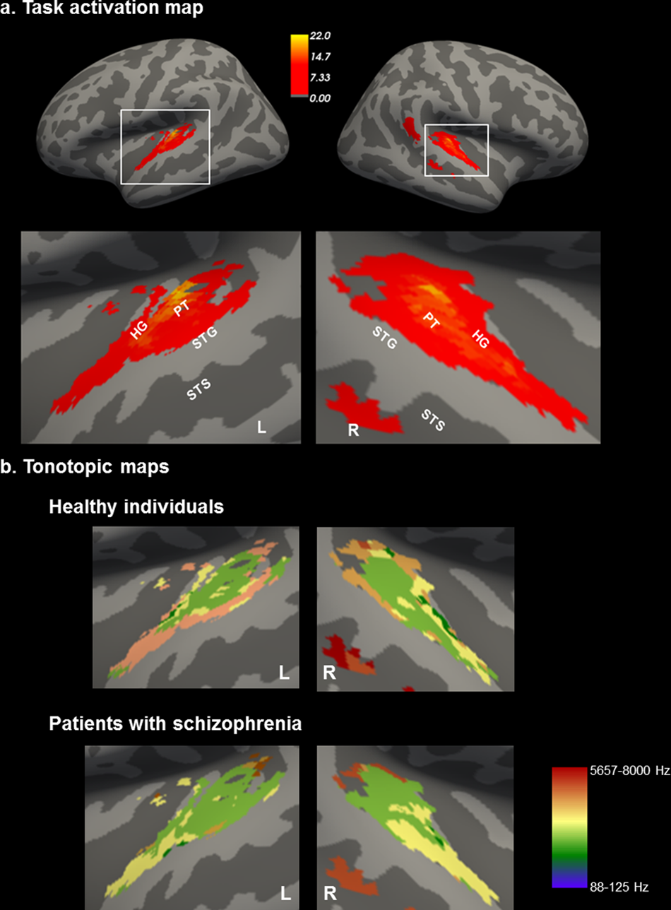 Tonotopic Map Auditory Cortex Abnormal Auditory Tonotopy In Patients With Schizophrenia | Schizophrenia