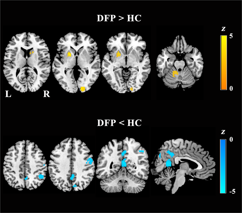 Fig. 3: Brain regions with functional differences between DFP and HC.