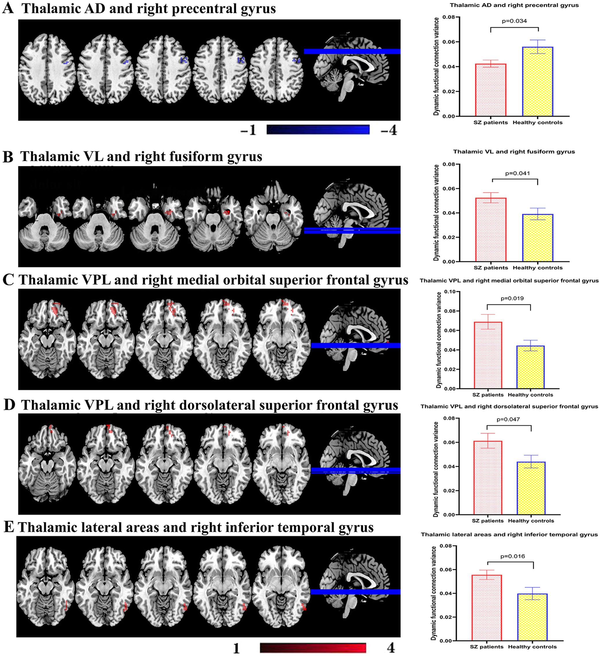 Fig. 1: Differences in the baseline dynamic functional connectivity of thalamus subdivisions between patients and healthy controls.