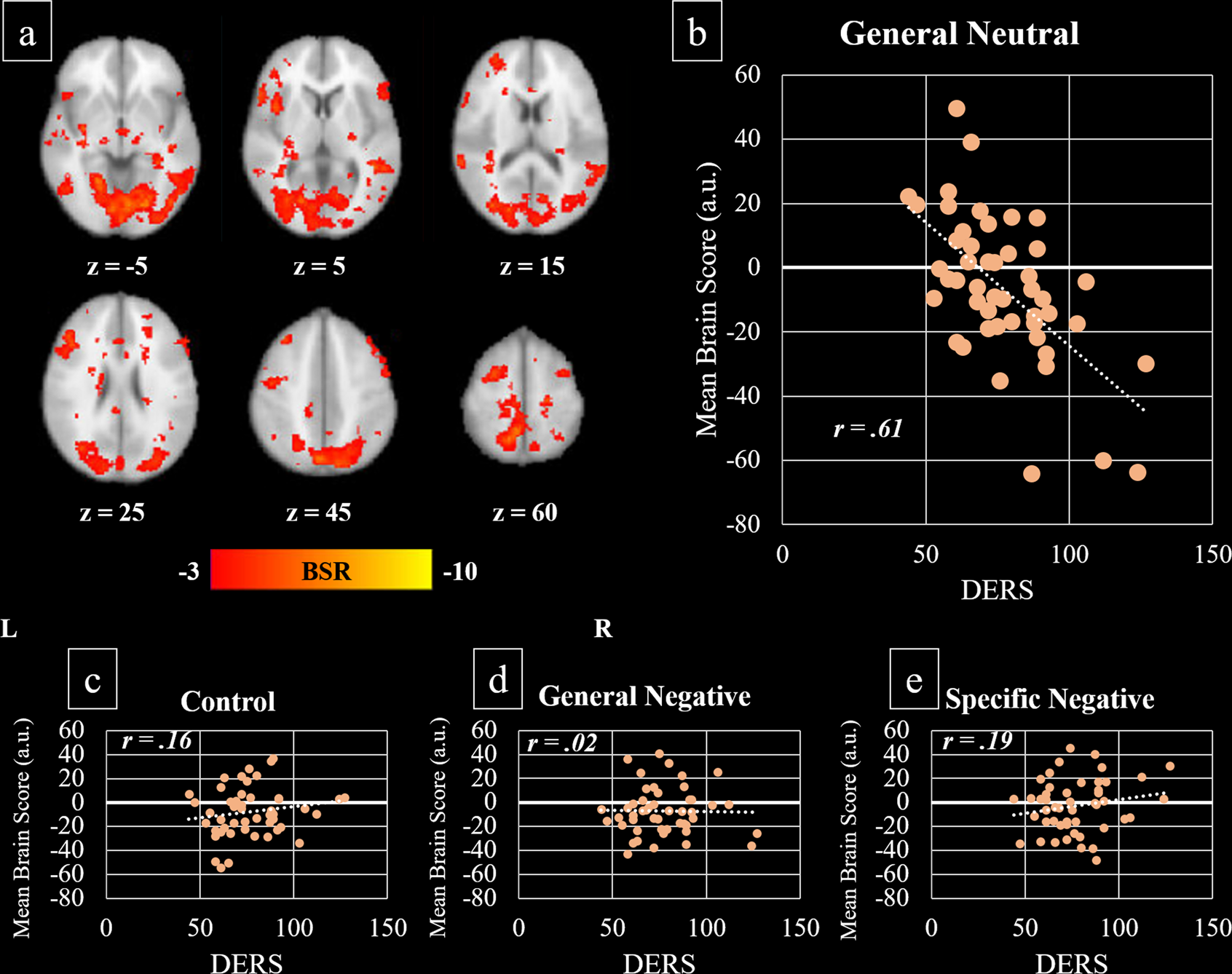 Fig. 2: Covariance of brain activity with DERS during the emotional Stroop task.
