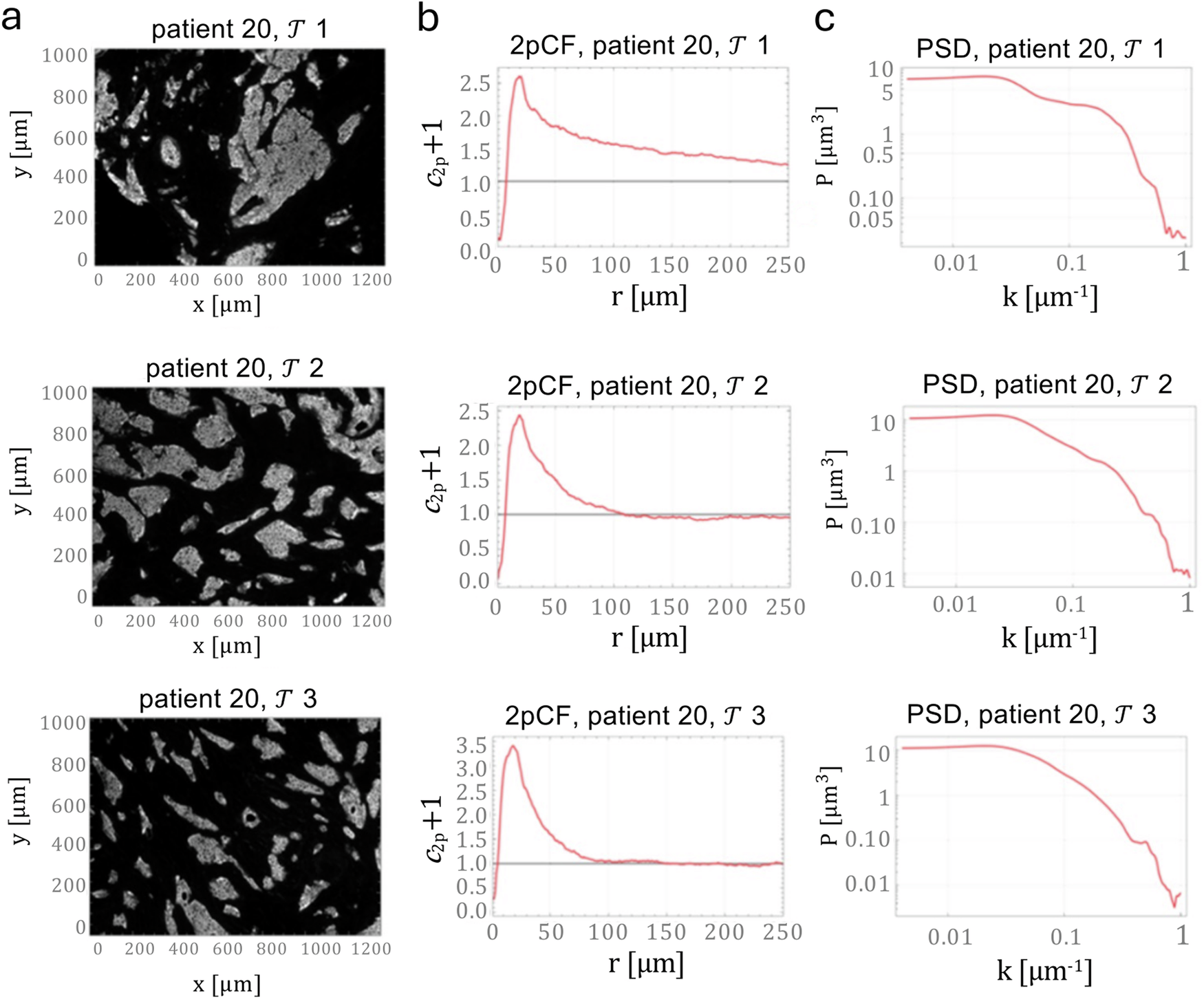 Fig. 3: Spatial statistical analysis of patient biopsy tissues.