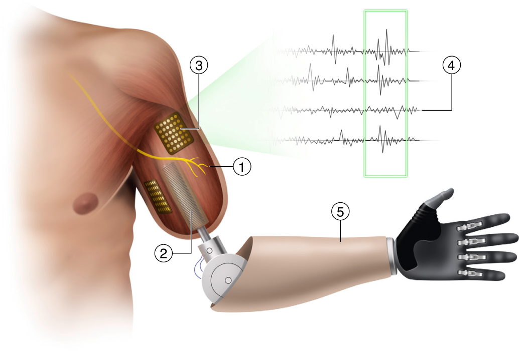 Algorithm may improve brain-controlled prostheses and exoskeletons