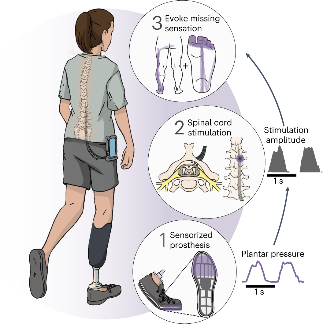 Next-gen Device Could Relieve Phantom Limb Pain