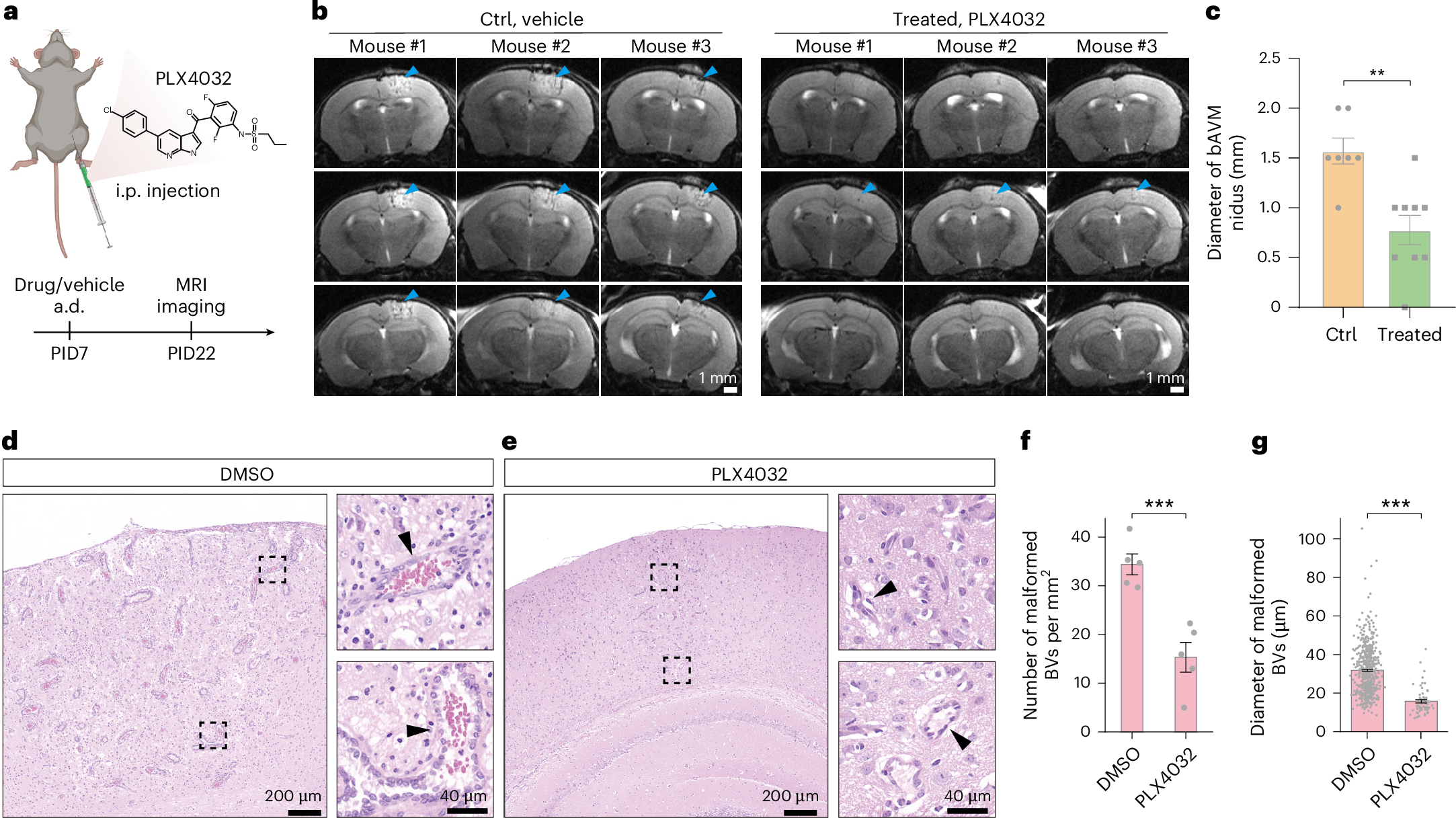 Fig. 5: Treatment of bAVM with PLX4032.