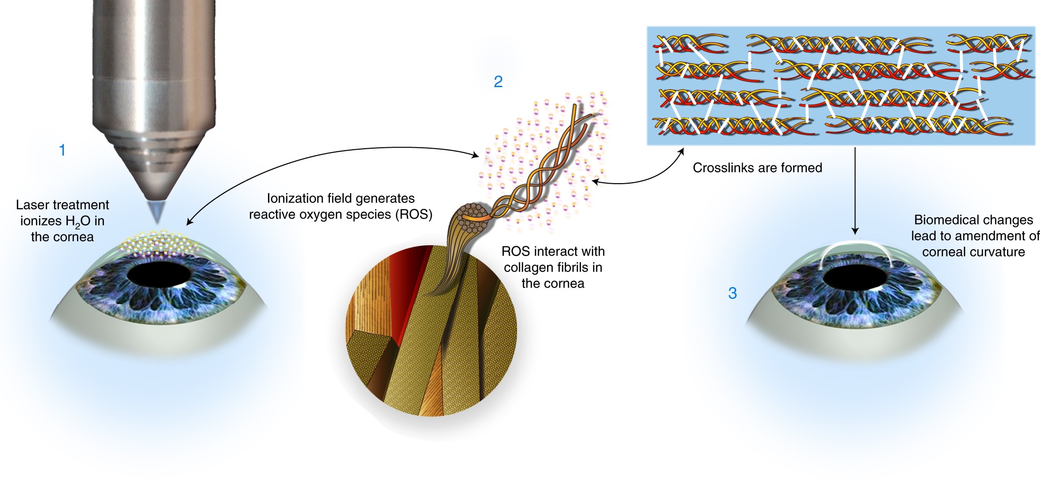 Femtosecond laser crosslinking of the cornea for non-invasive vision  correction | Nature Photonics