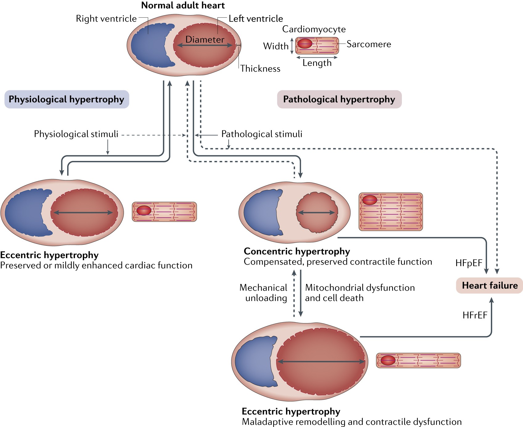 hypertrophy of the heart