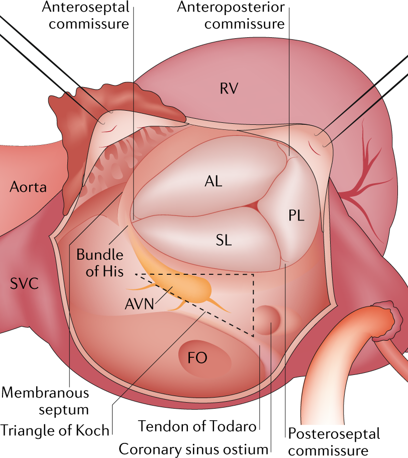 Tricuspid valve disease: diagnosis, prognosis and management of a rapidly  evolving field