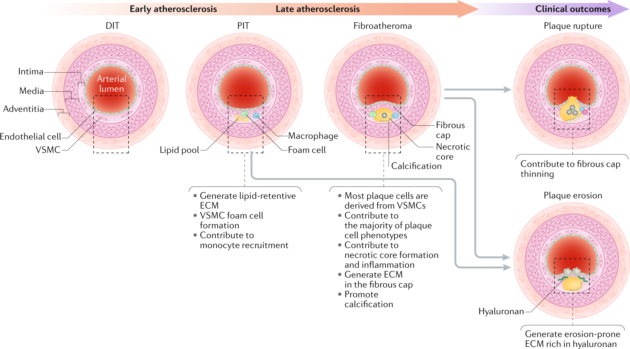 Vascular smooth muscle cells in atherosclerosis | Nature Reviews Cardiology