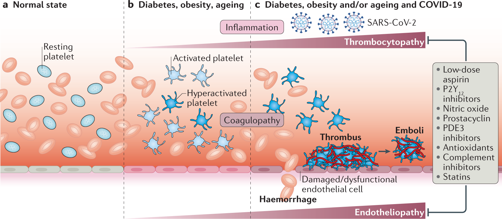 Endothelial cell infection and endotheliitis in COVID-19 - The Lancet