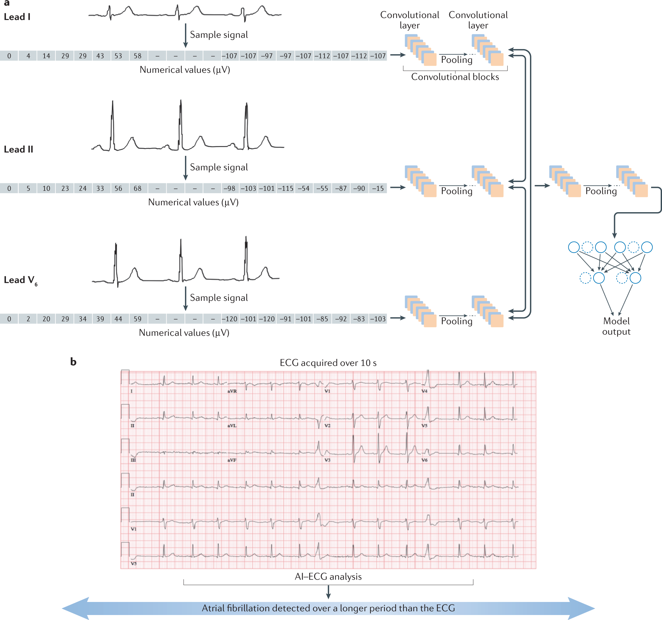 Artificial intelligence-enhanced electrocardiography in