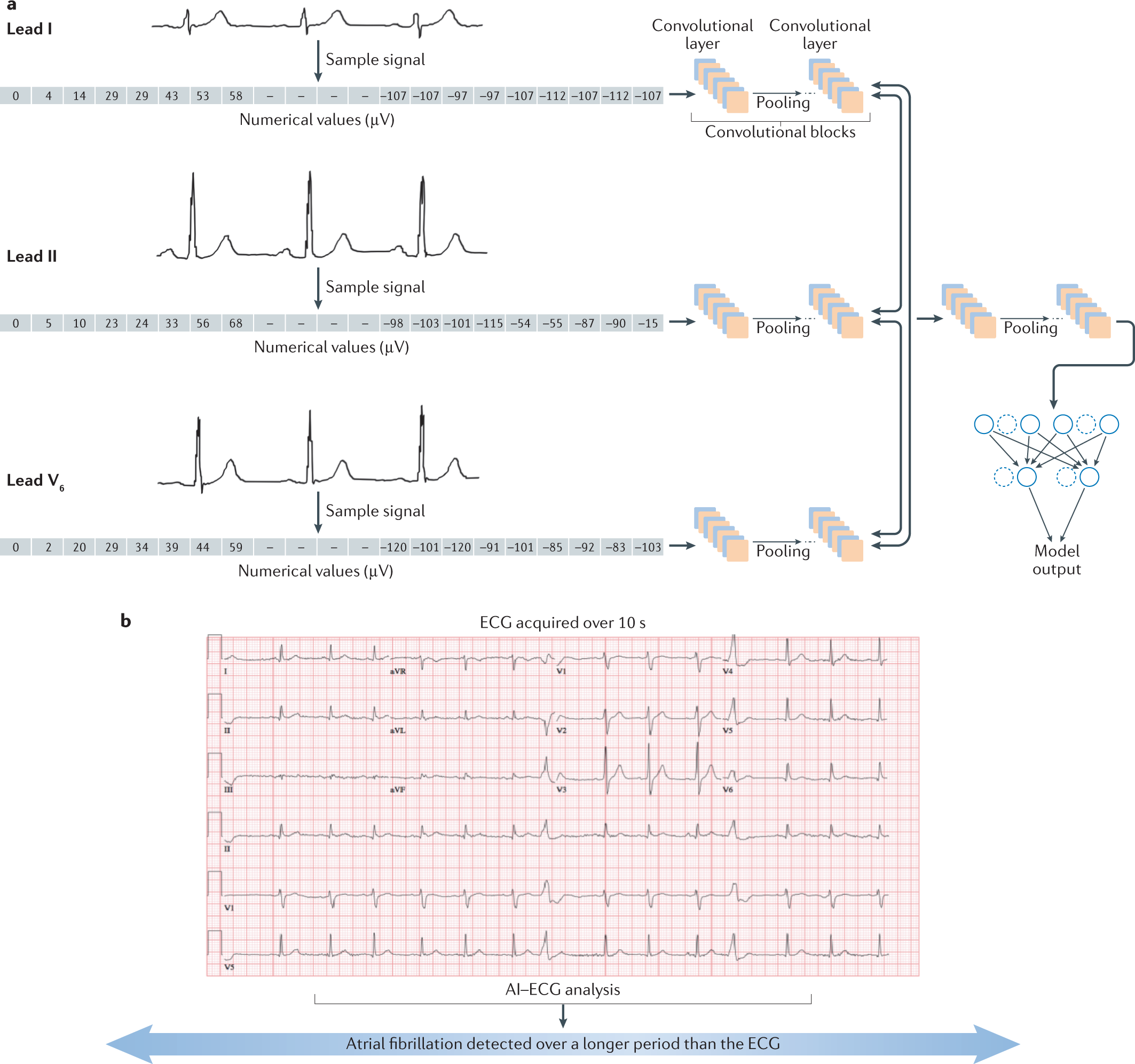 AI Accurately Detects LV Dysfunction Using Single-Lead Apple Watch ECG