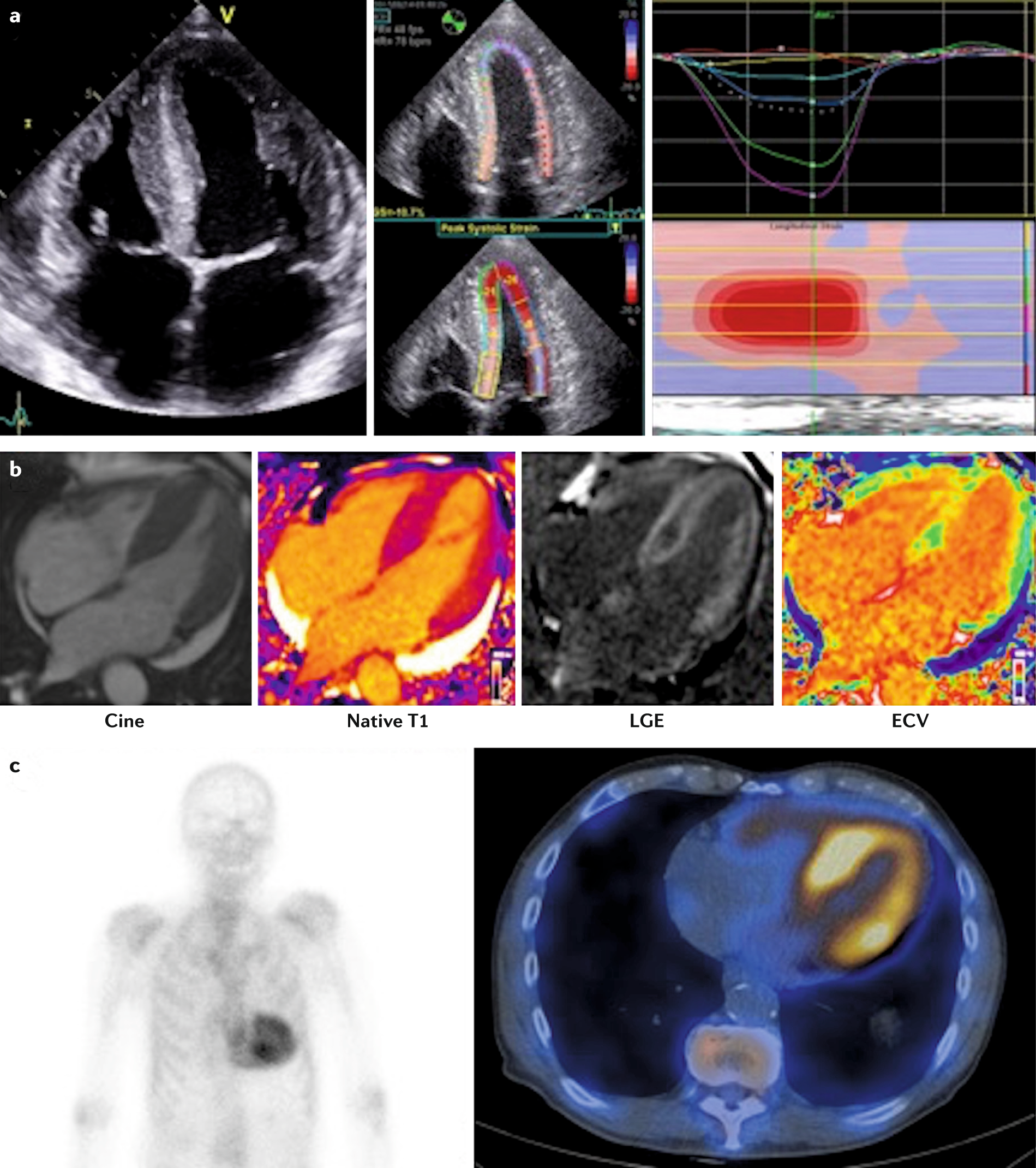 Prognostic Utility of Echocardiographic Atrial and Ventricular Strain  Imaging in Patients With Cardiac Amyloidosis