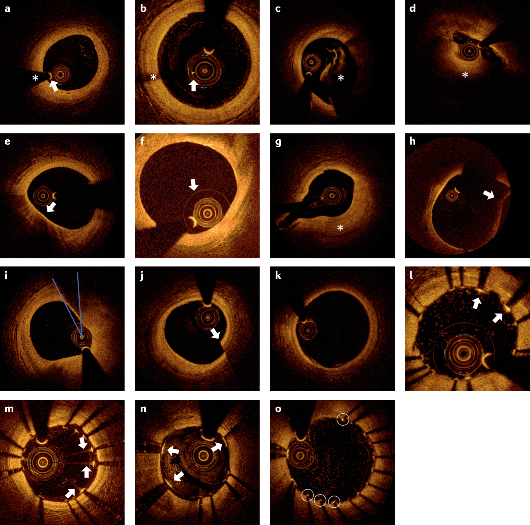 Optical coherence tomography in coronary atherosclerosis assessment and  intervention | Nature Reviews Cardiology