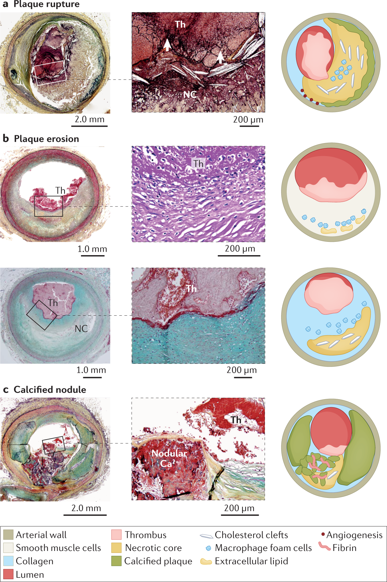 A Definition of Advanced Types of Atherosclerotic Lesions and a  Histological Classification of Atherosclerosis