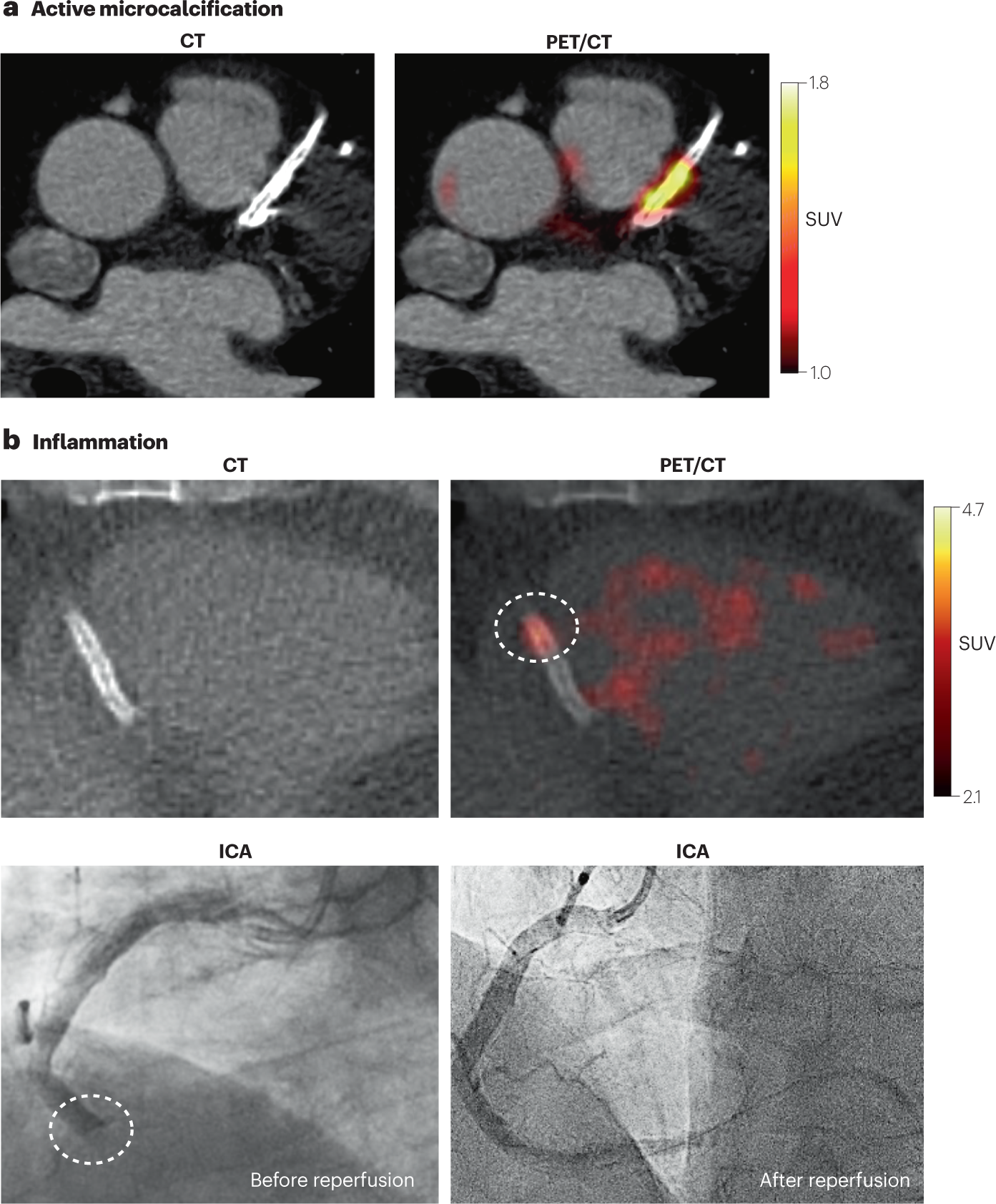 Fig. 7: PET for quantitative coronary atherosclerosis imaging.
