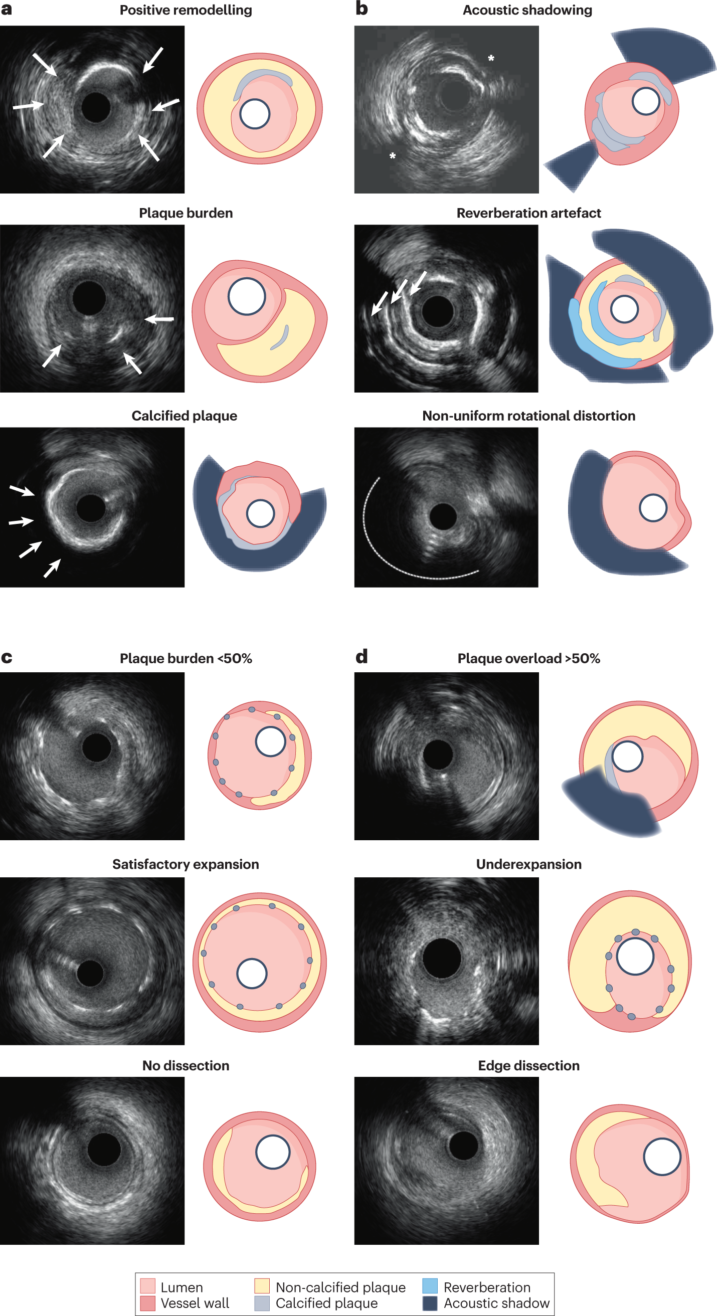 Fig. 9: IVUS for quantitative coronary atherosclerosis imaging.