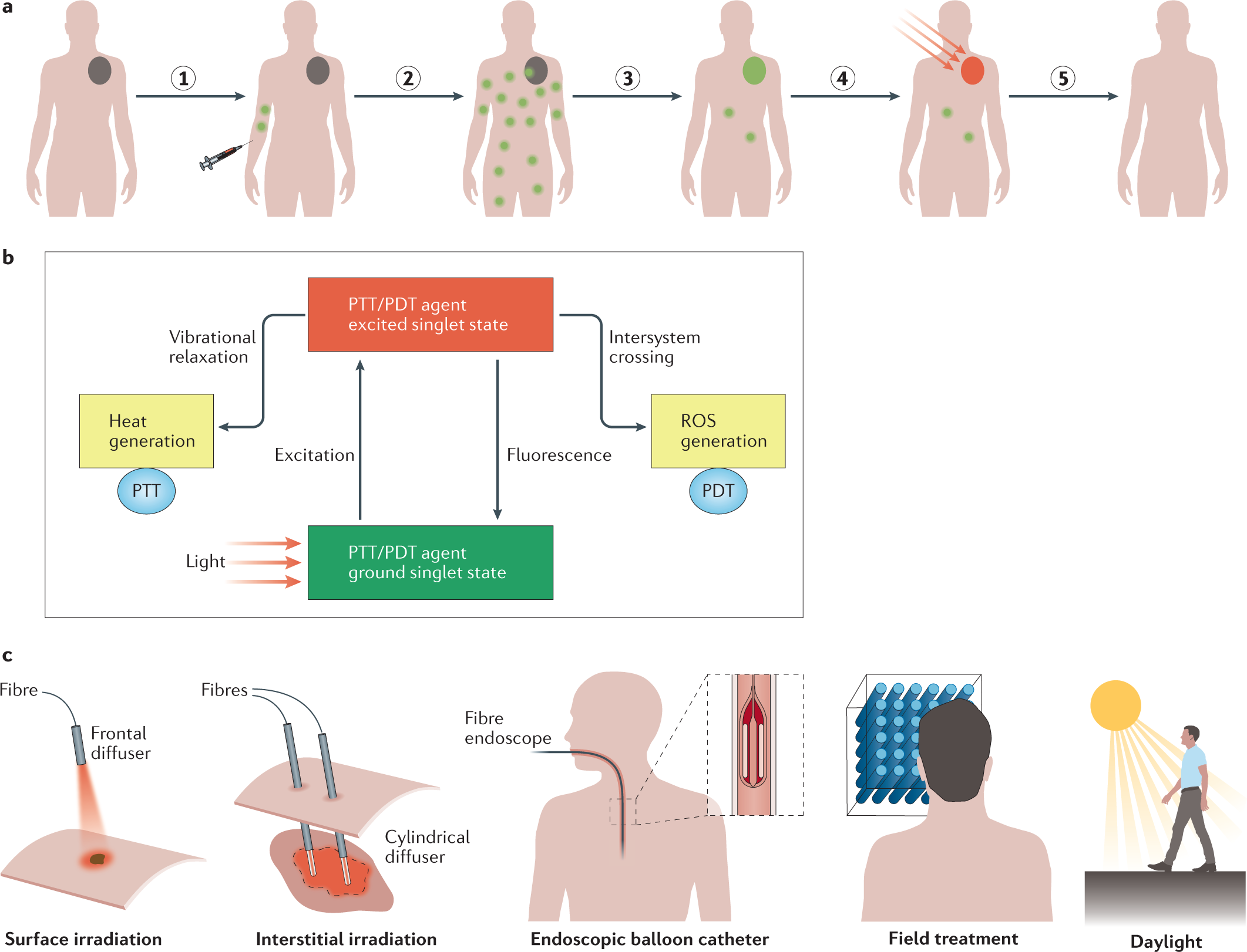 Clinical development and potential of photothermal and photodynamic  therapies for cancer | Nature Reviews Clinical Oncology