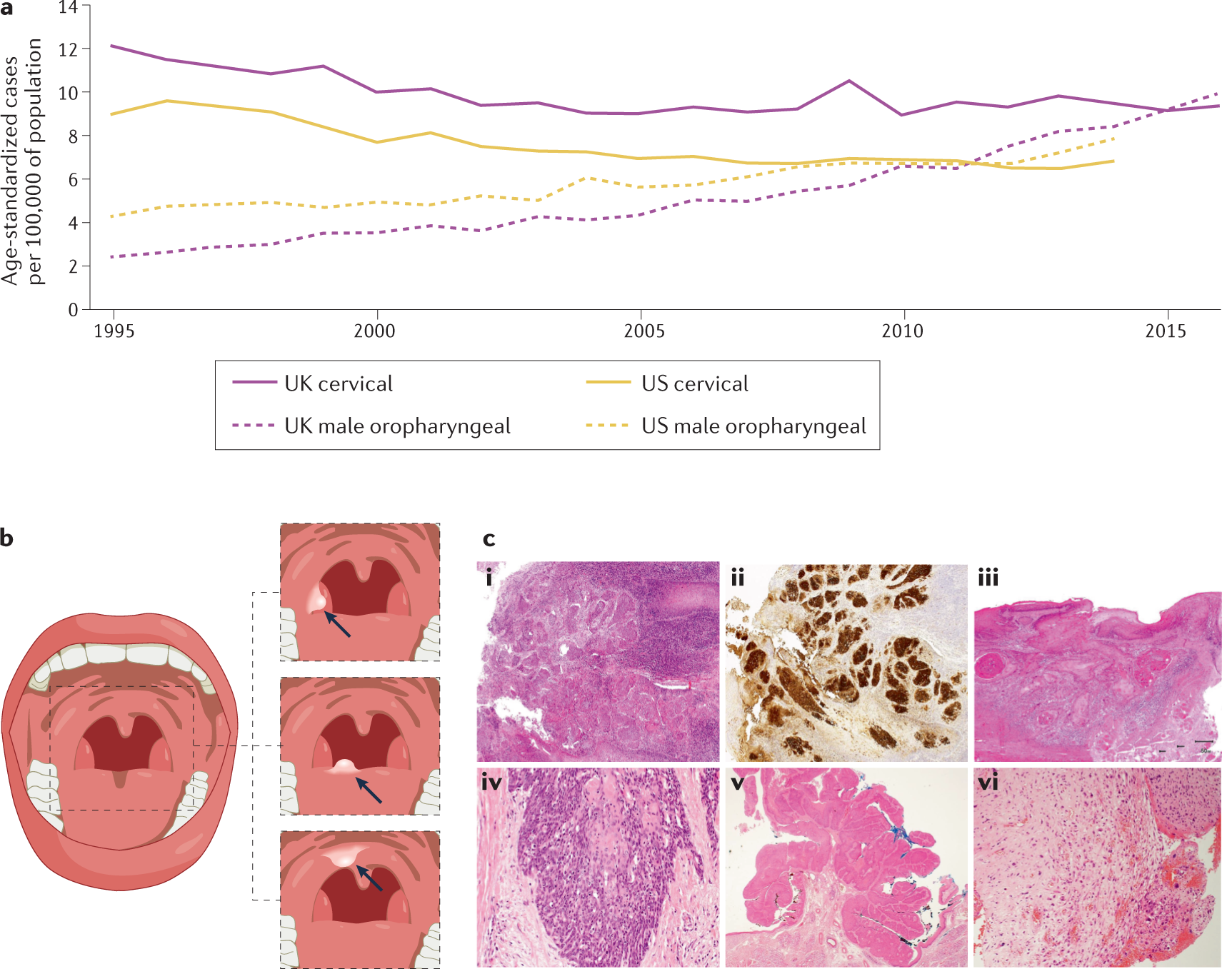 HPV-associated oropharyngeal cancer: epidemiology, molecular biology and  clinical management | Nature Reviews Clinical Oncology