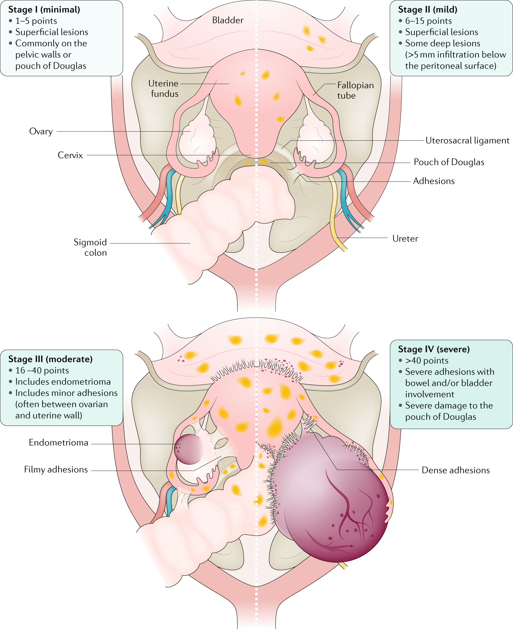Endometriosis  Nature Reviews Disease Primers