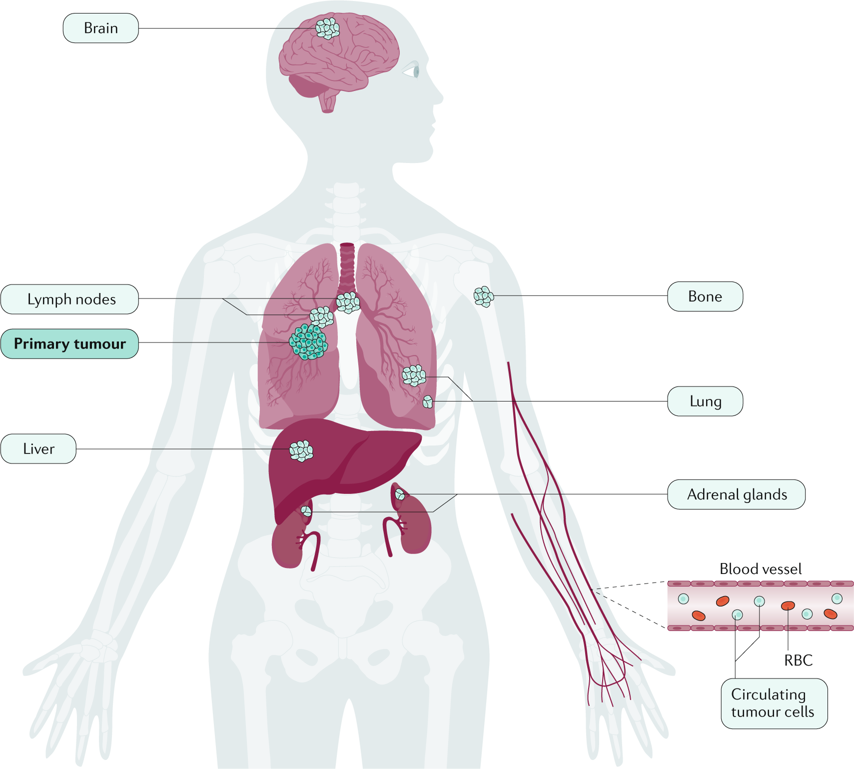 lung cancer cells diagram