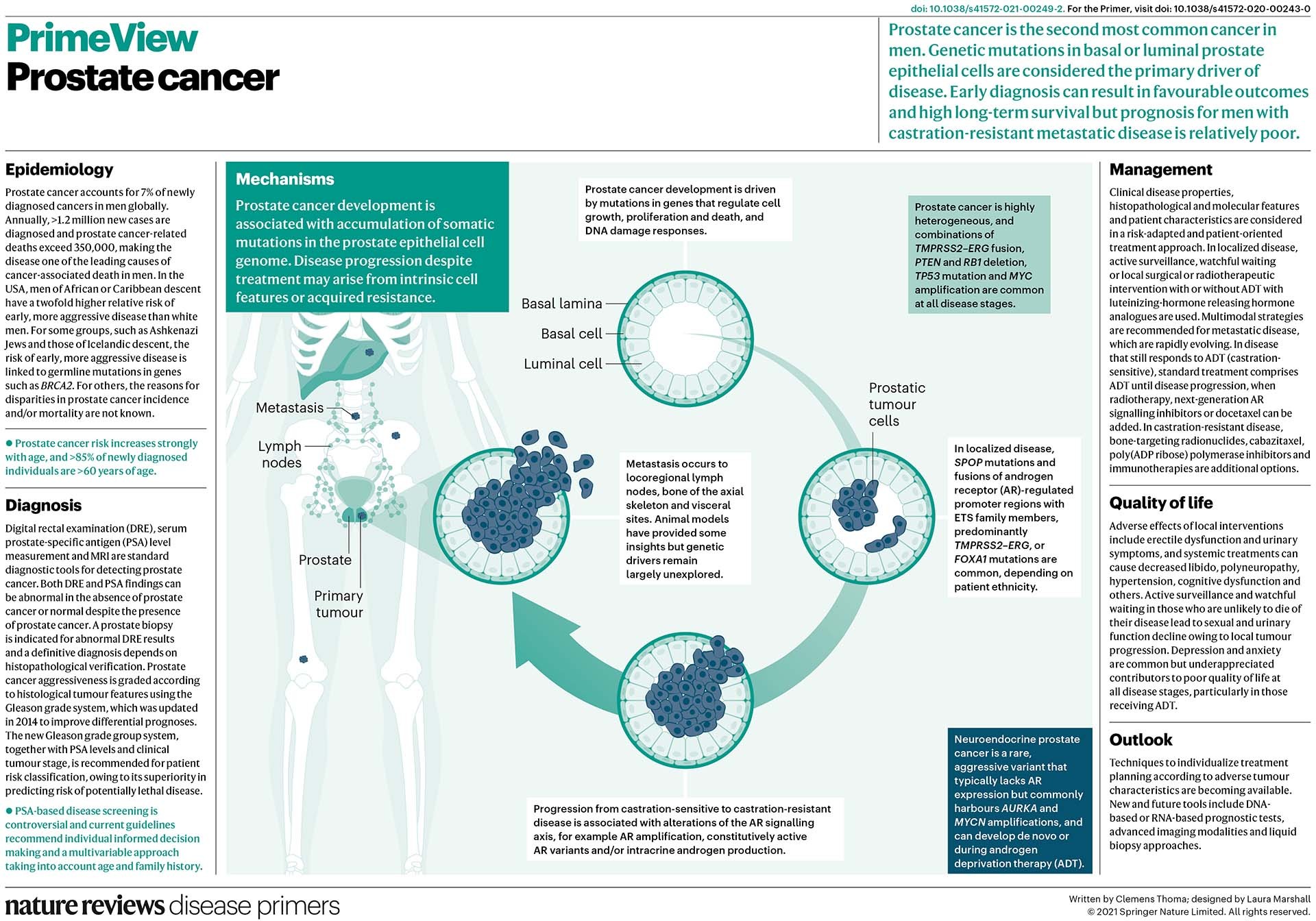 prostate cancer diagnosis journal