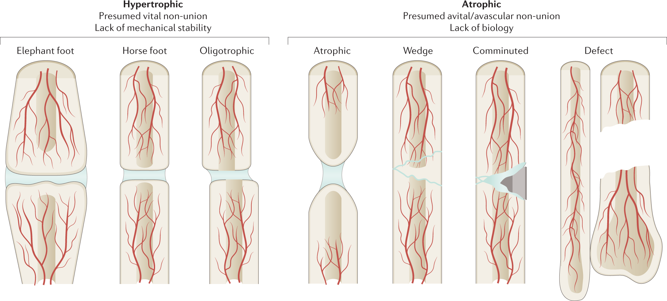 Non-union bone fractures | Nature Reviews Disease Primers