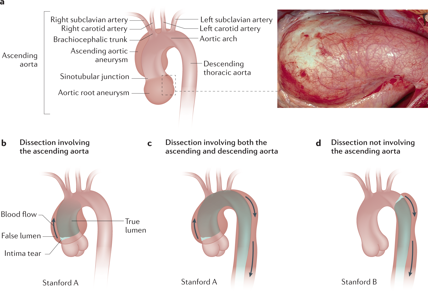 Marfan Syndrome V. Loeys-Dietz Syndrome