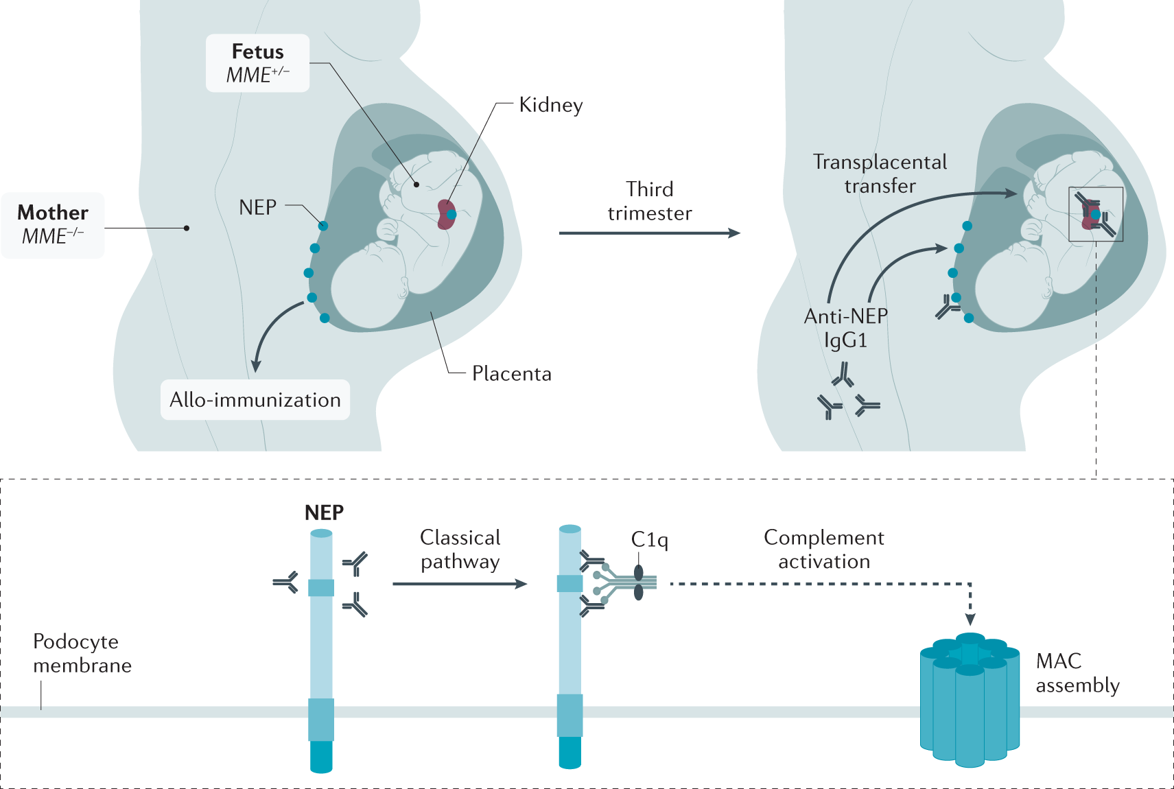 membranous nephropathy nature reviews disease primers