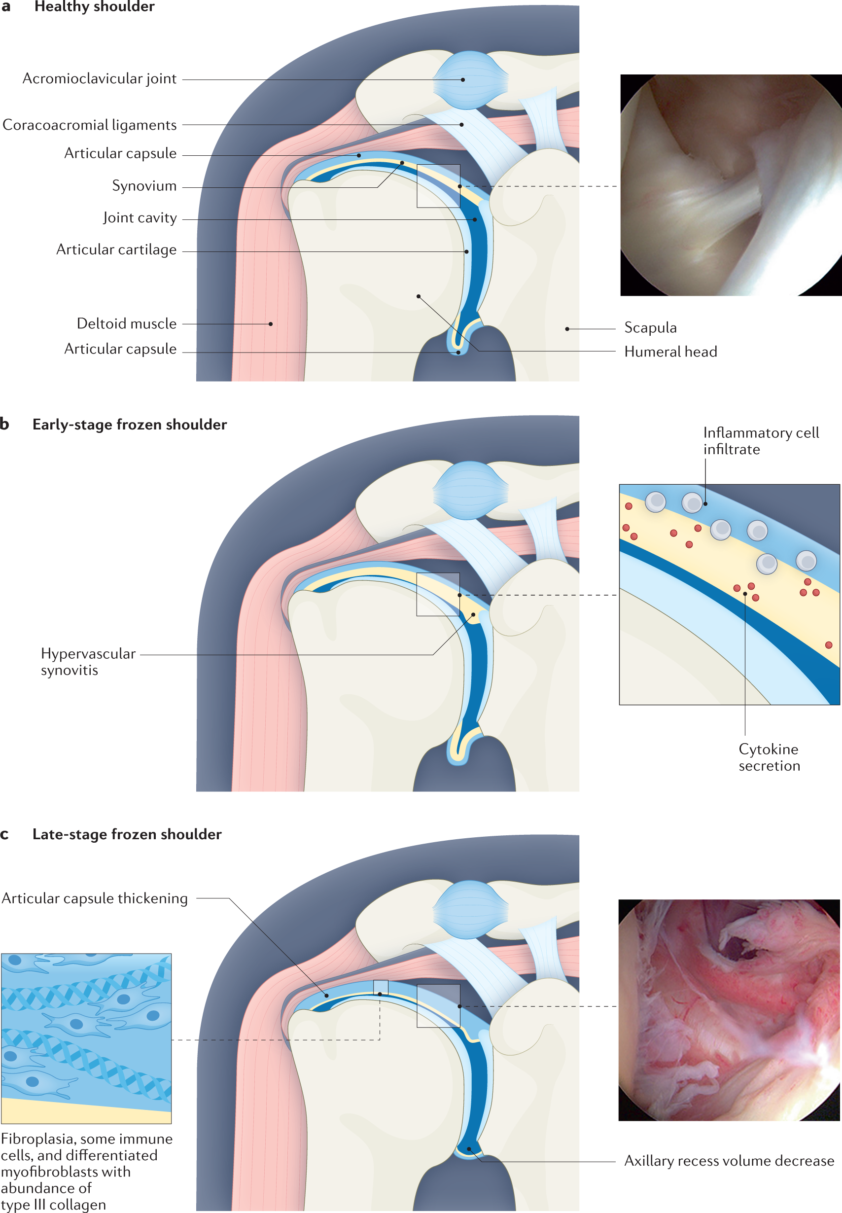 Frozen shoulder  Nature Reviews Disease Primers