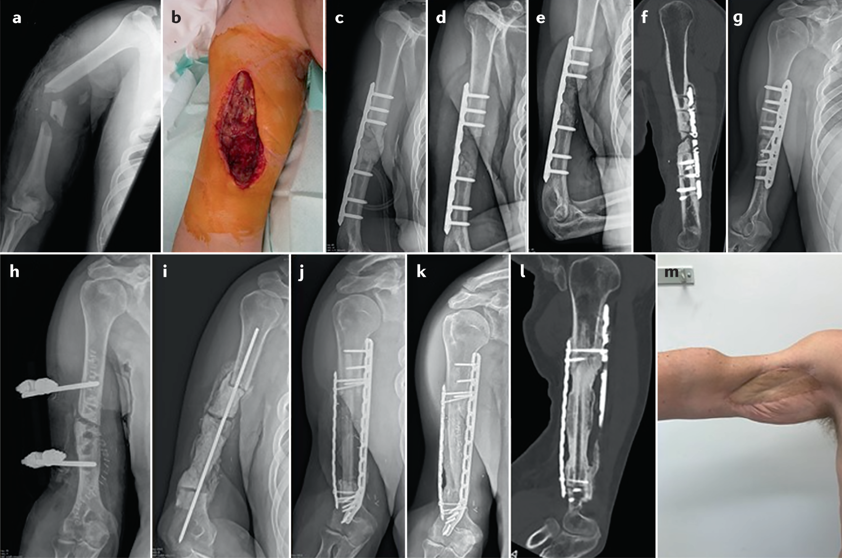 Plate osteosynthesis combined with bone cement provides the