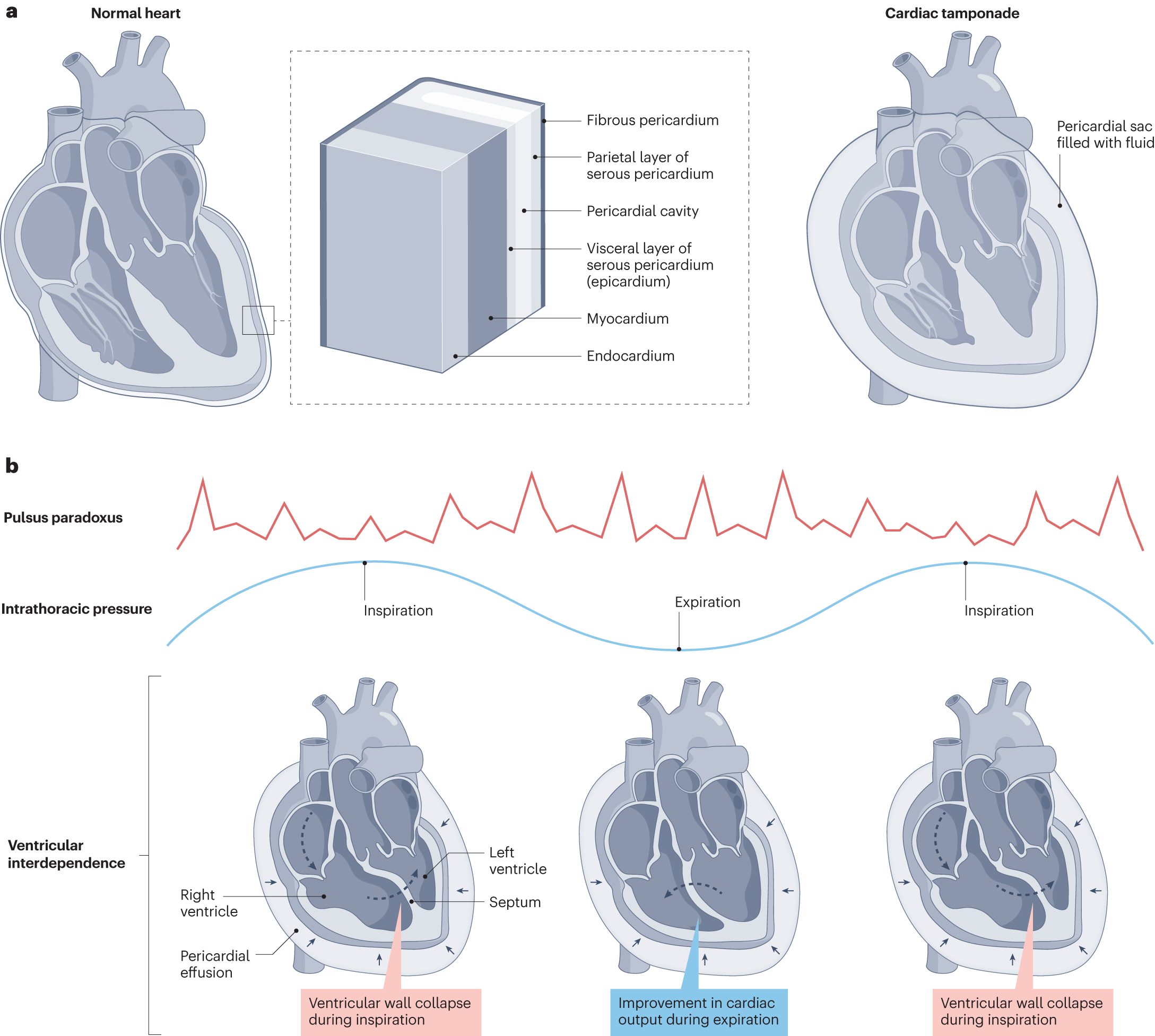 Cardiac tamponade | Nature Reviews Disease Primers