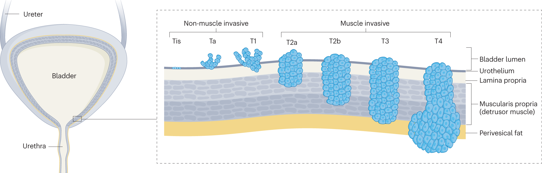 Bladder cancer | Nature Reviews Disease Primers