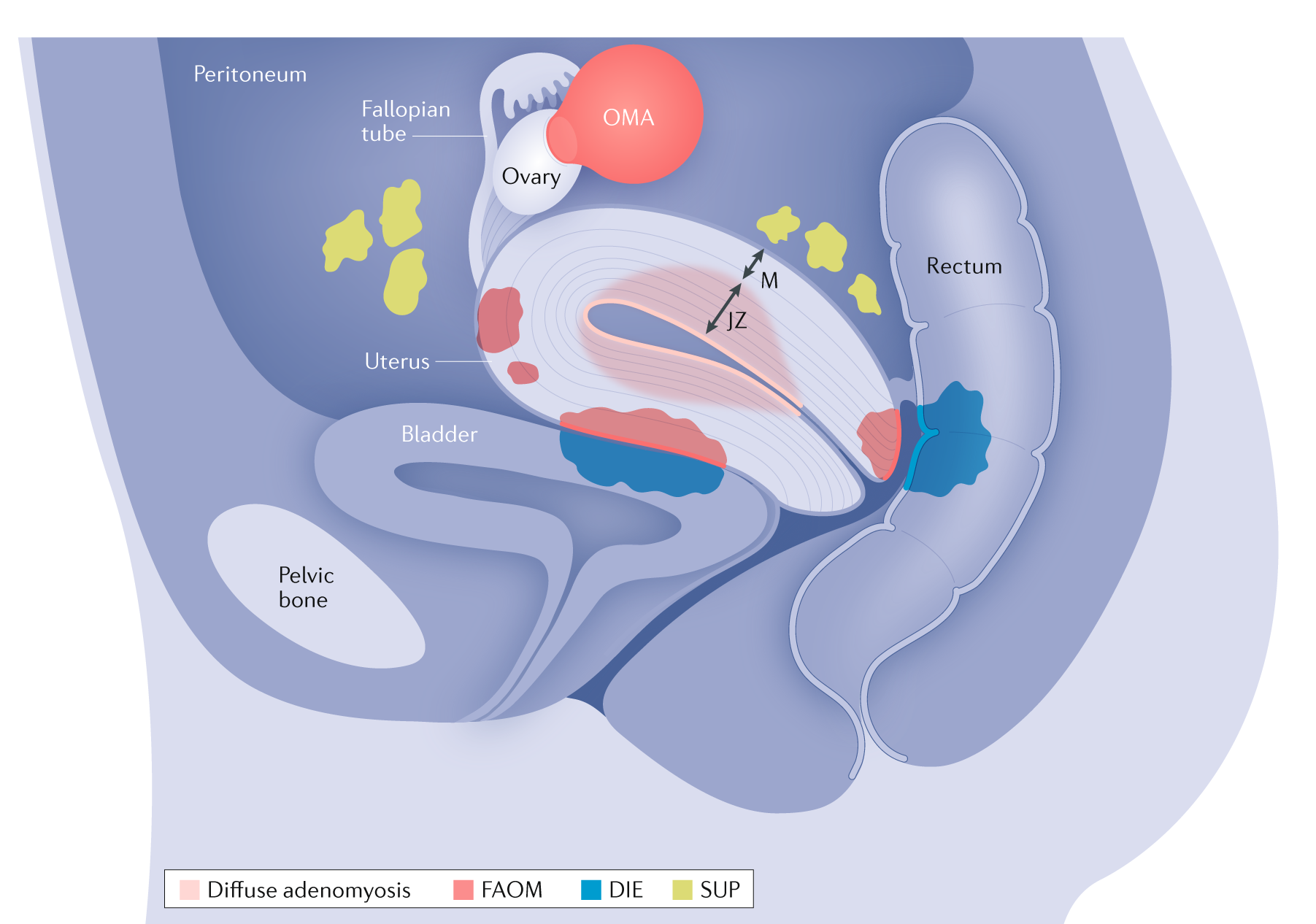 The Link Between Endometriosis and Abnormal Bleeding: Collaborative Women's  Care: Obstetrics and Gynecologist