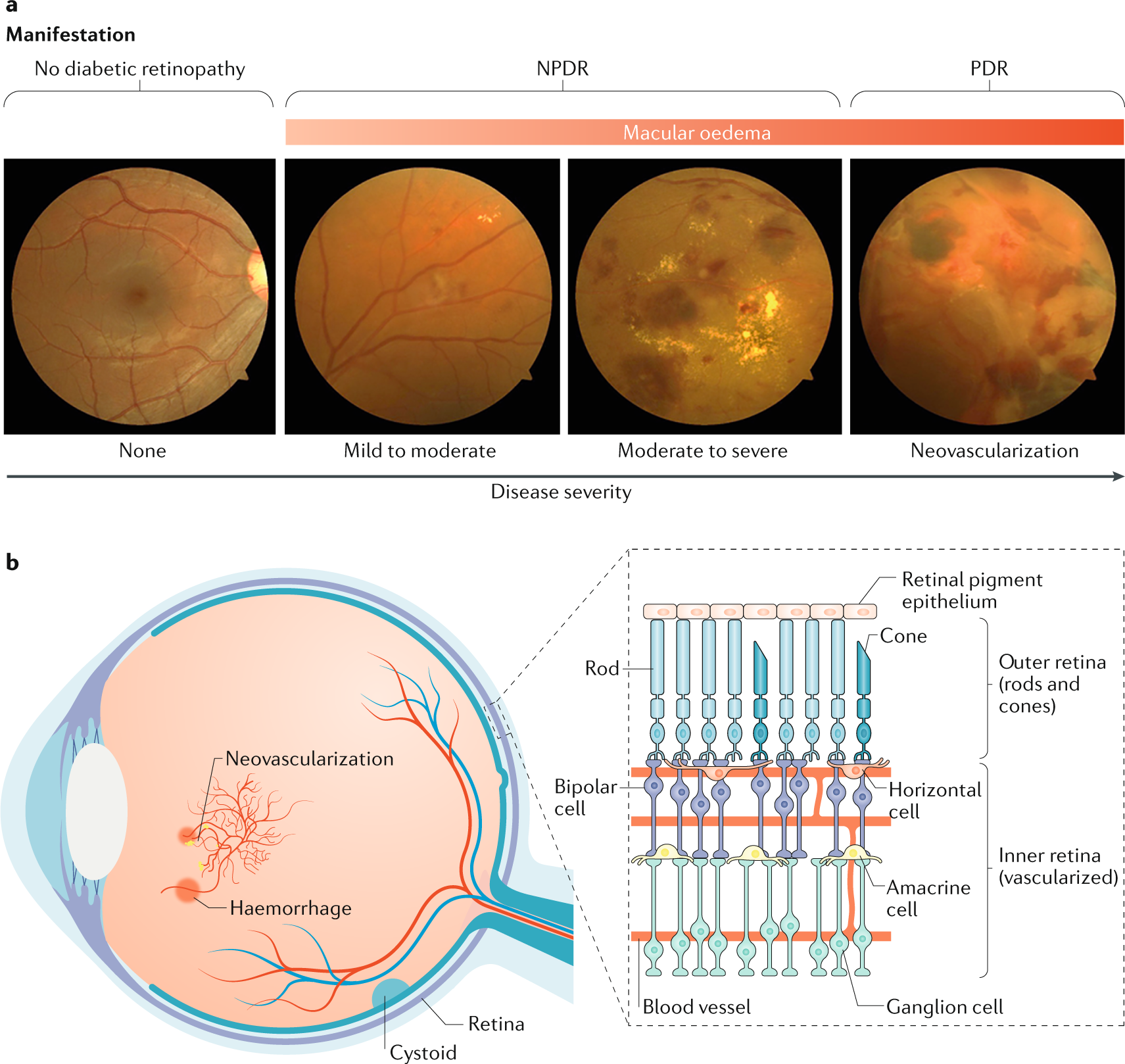 Diabetes and diabetic retinopathy in people aged 50 years and older in Hungary
