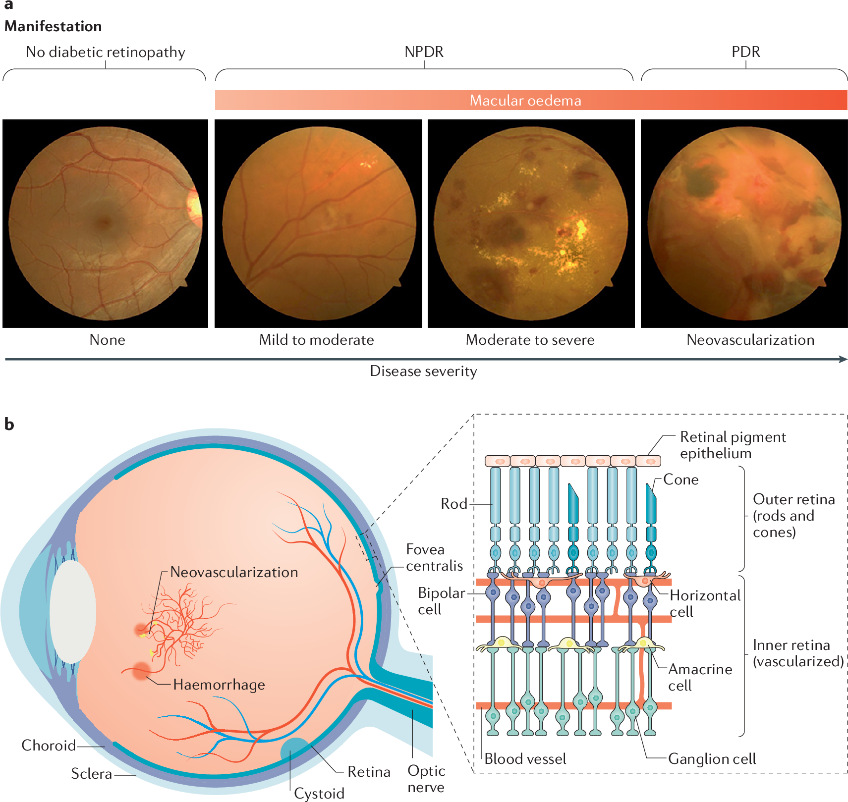 kezelése retinopathia diabetes