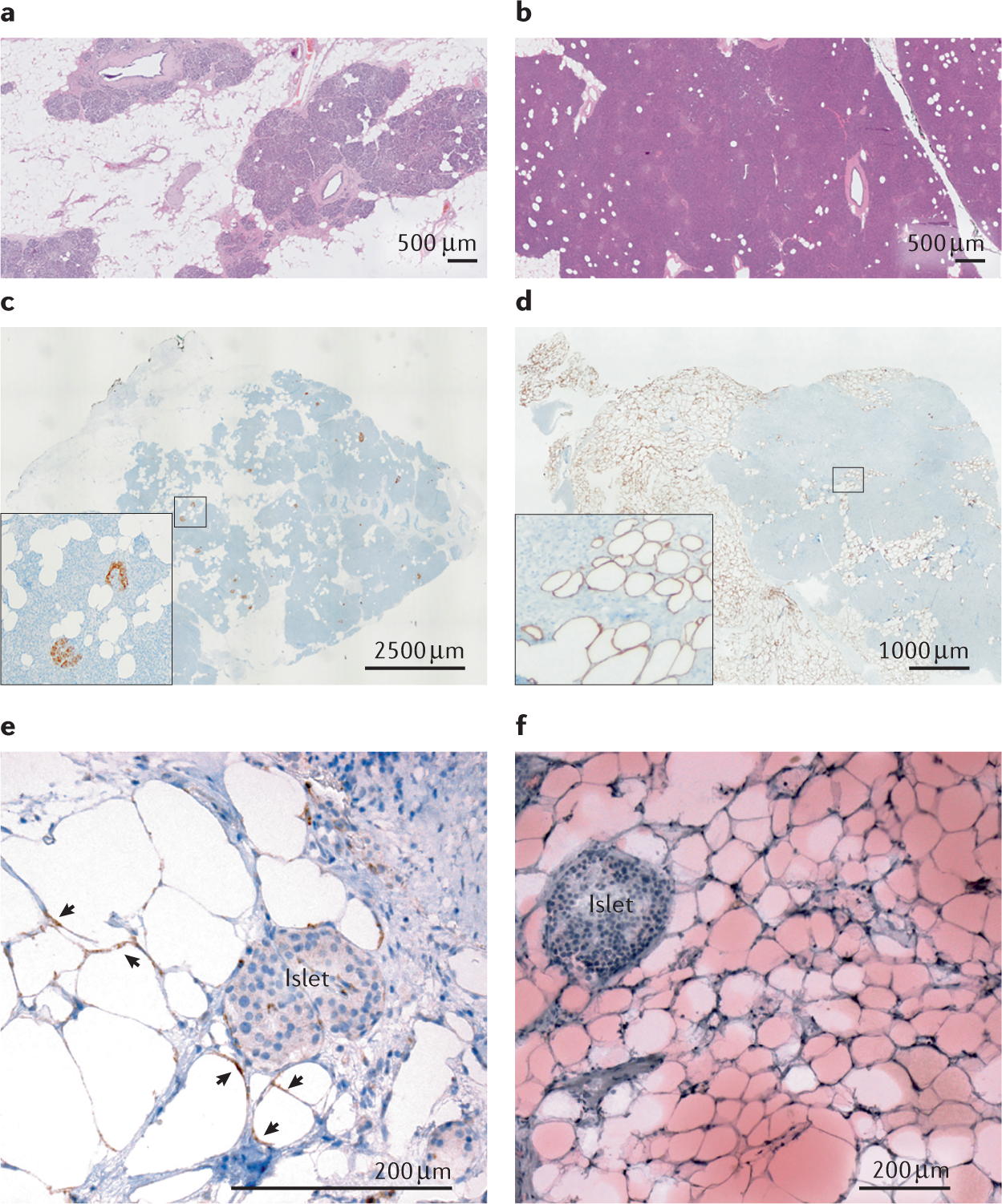 Metabolic Implications Of Pancreatic Fat Accumulation Nature Reviews Endocrinology