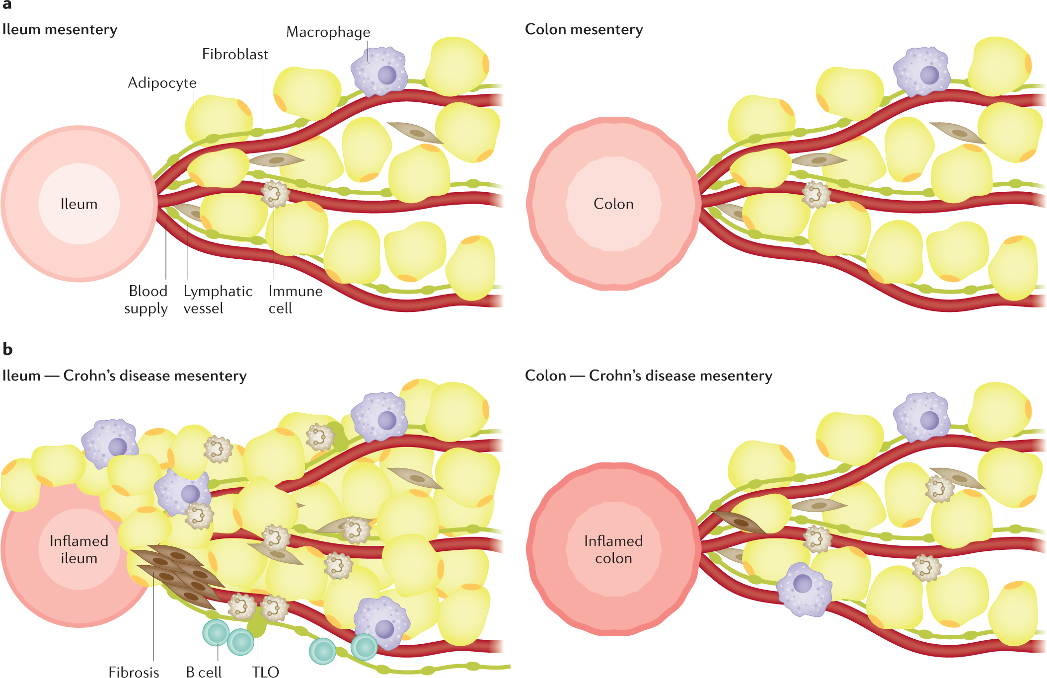 Location is important: differentiation between ileal and colonic Crohn's  disease